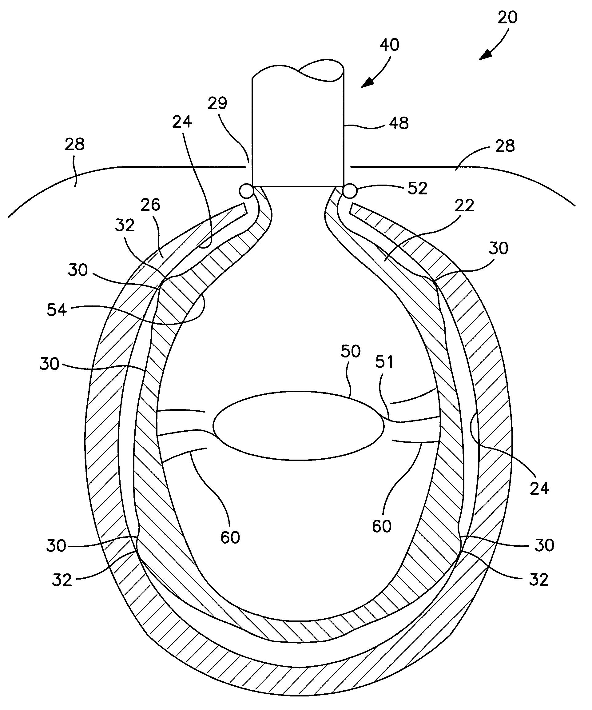 Interior bag for a capsular bag and injector