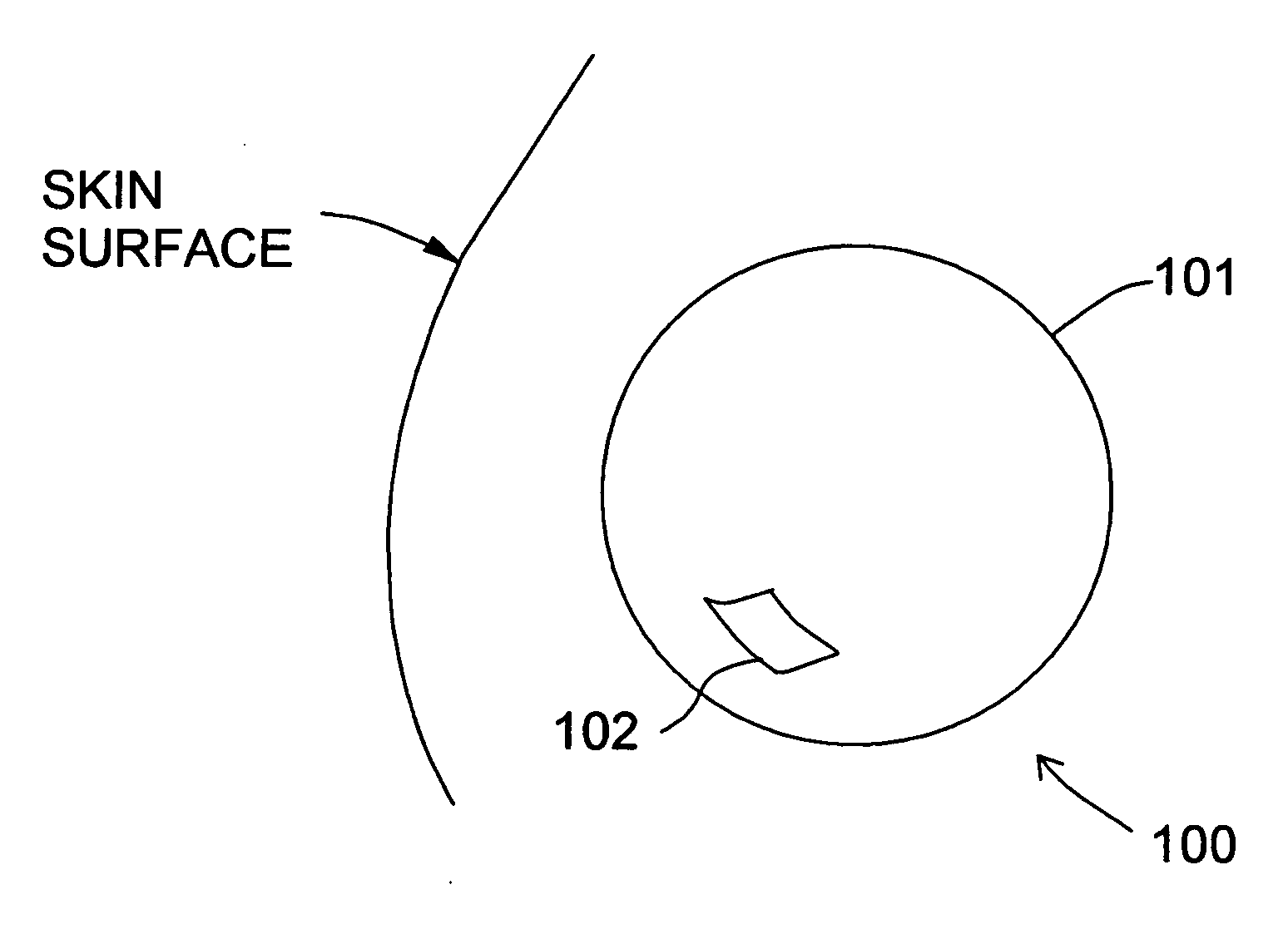 Balloon brachytherapy applicator and method