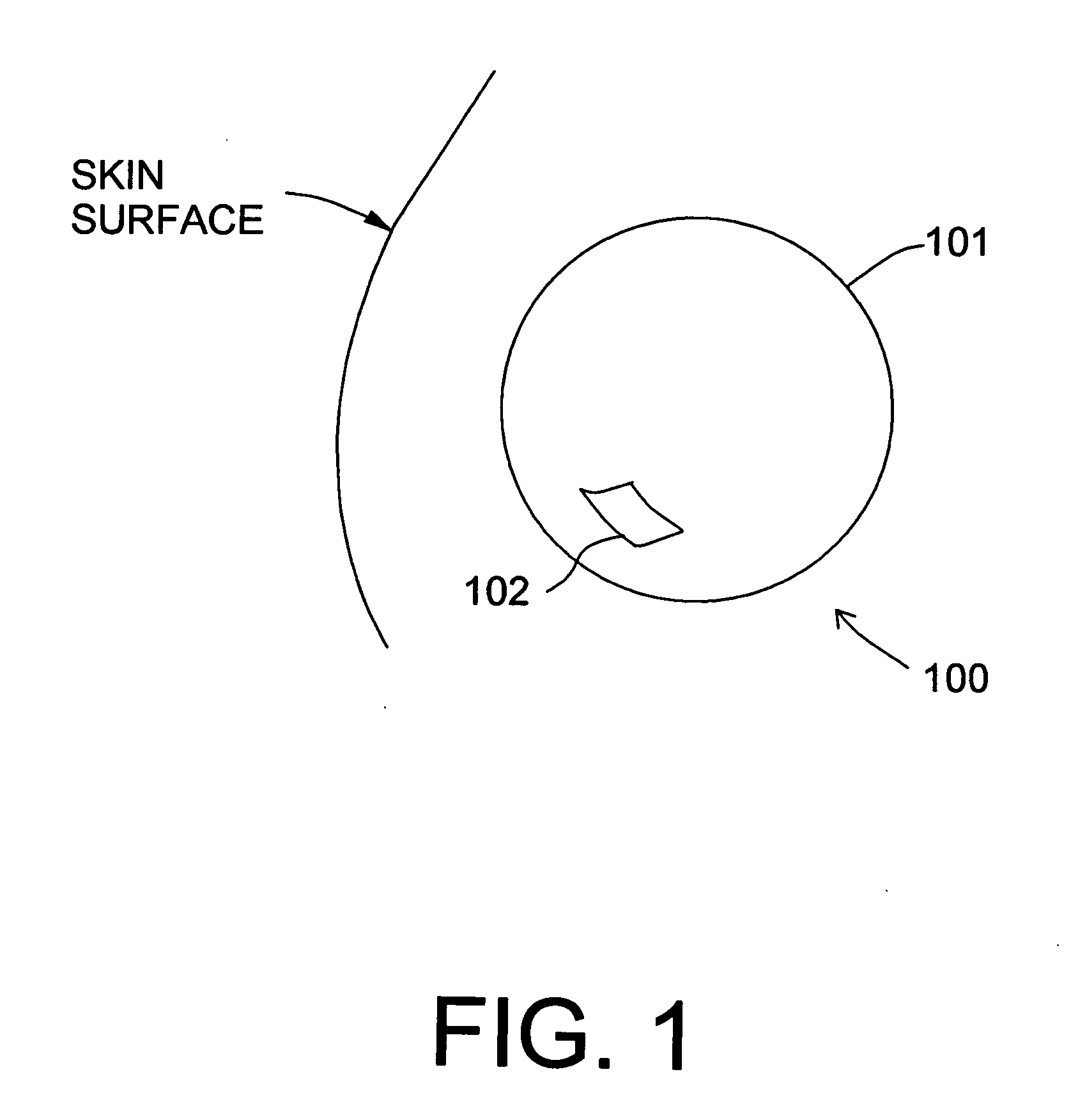 Balloon brachytherapy applicator and method