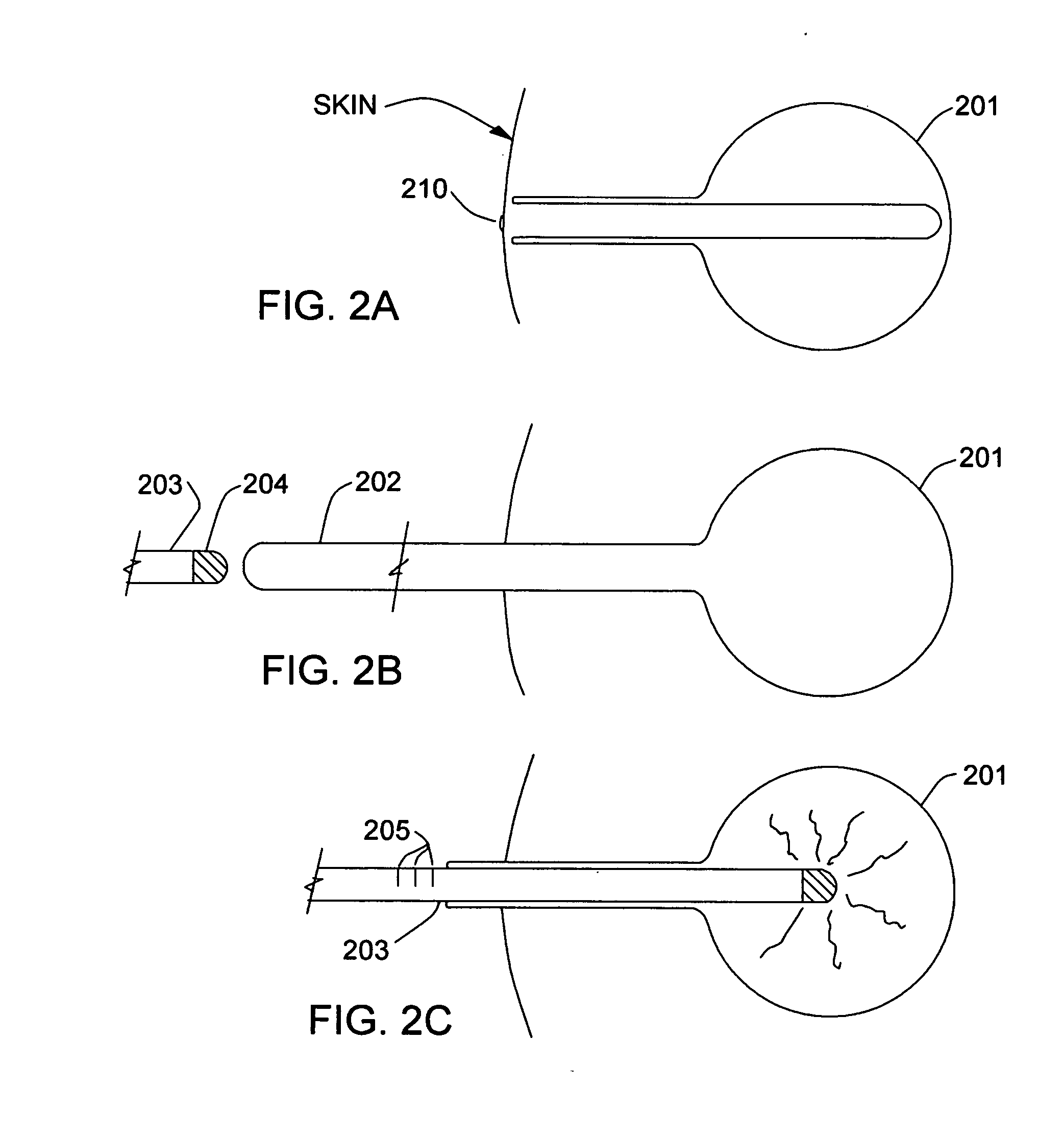 Balloon brachytherapy applicator and method