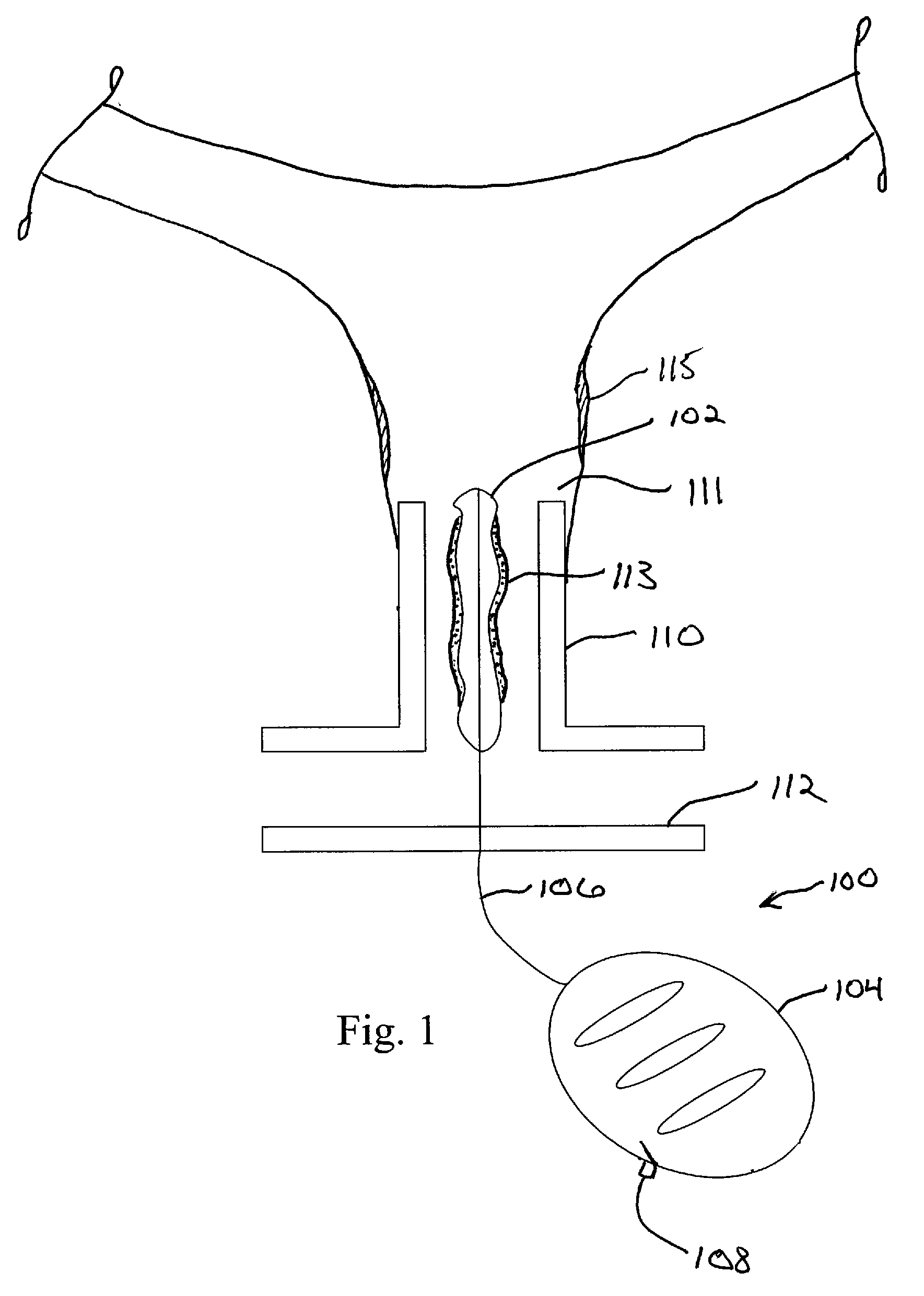 CryoBalloon Treatment for Postpartum Hemorrhage