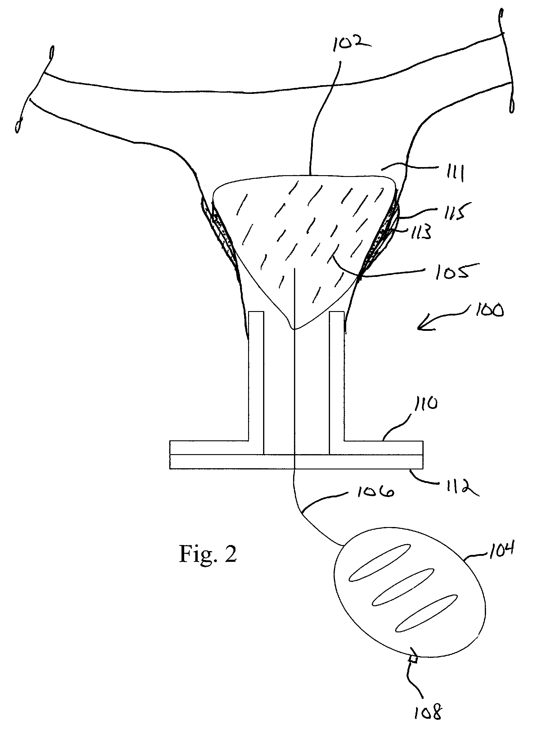 CryoBalloon Treatment for Postpartum Hemorrhage