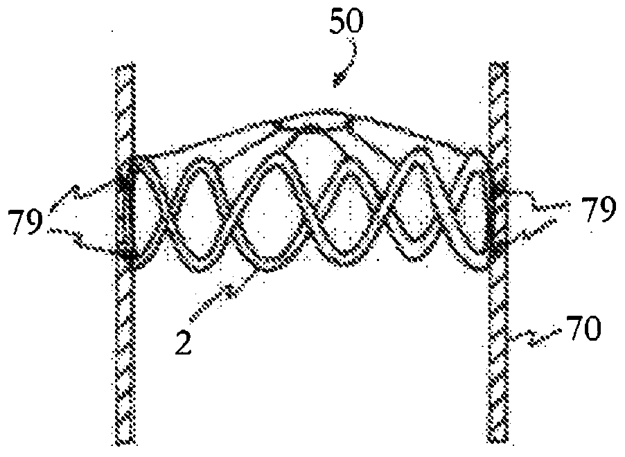 Absorbable vascular filter