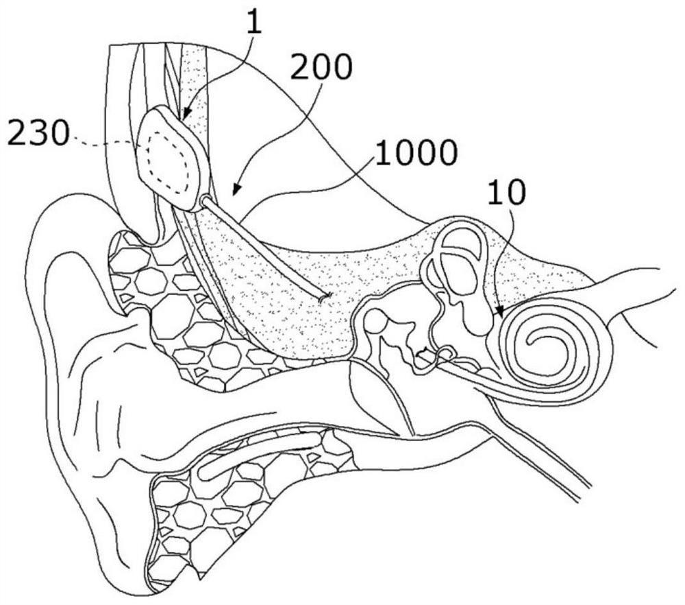 Electrode array and body implantable device including same