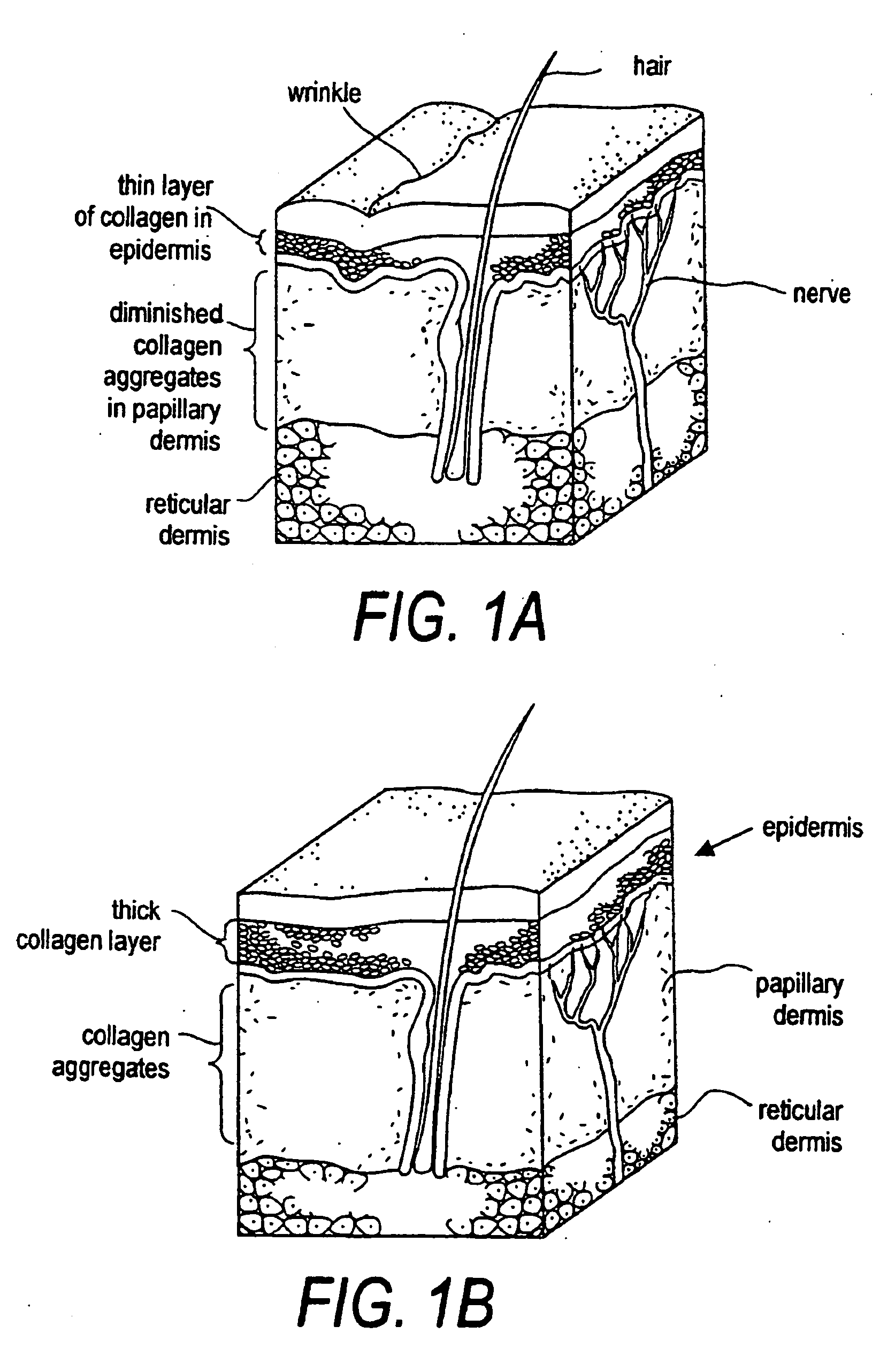 Instruments and techniques for controlled removal of epidermal layers