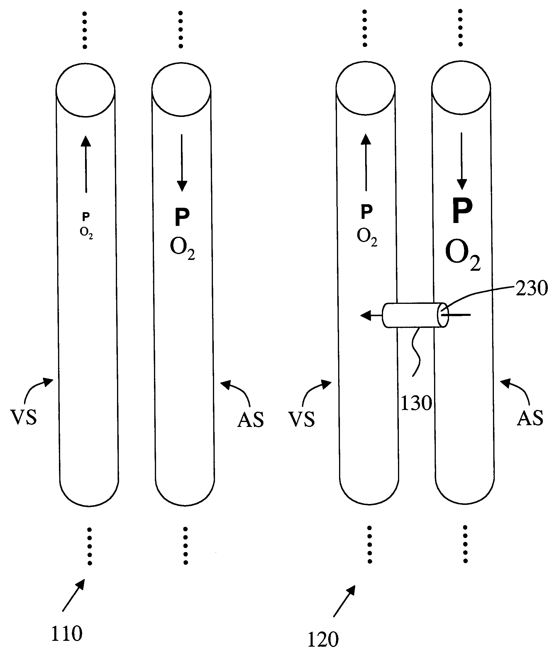 Implantable arterio-venous shunt devices and methods for their use