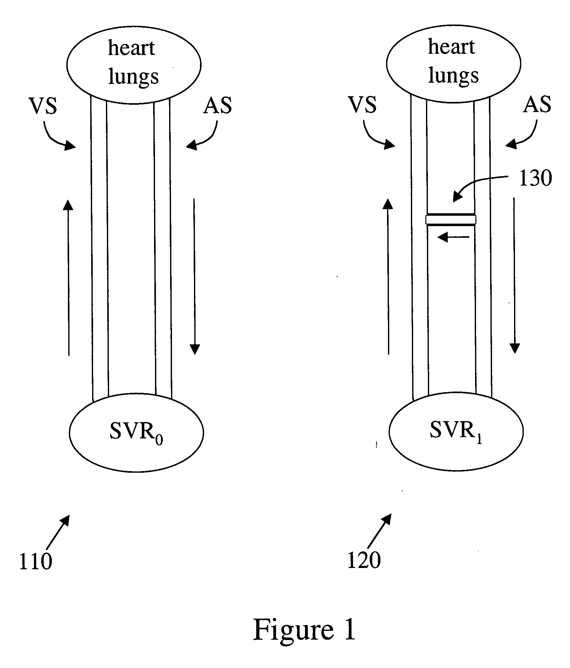 Implantable arterio-venous shunt devices and methods for their use