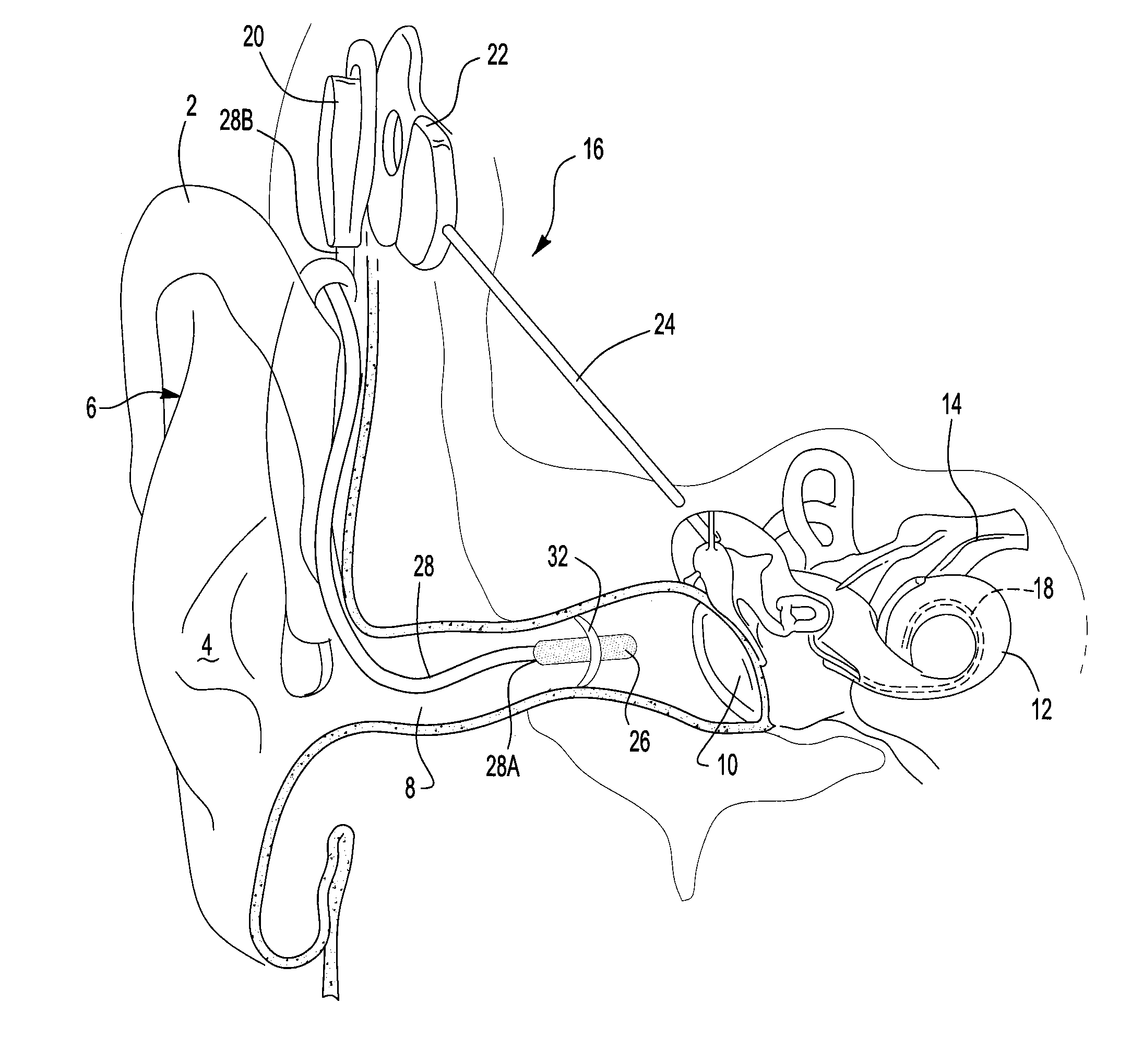 Cochlear implant