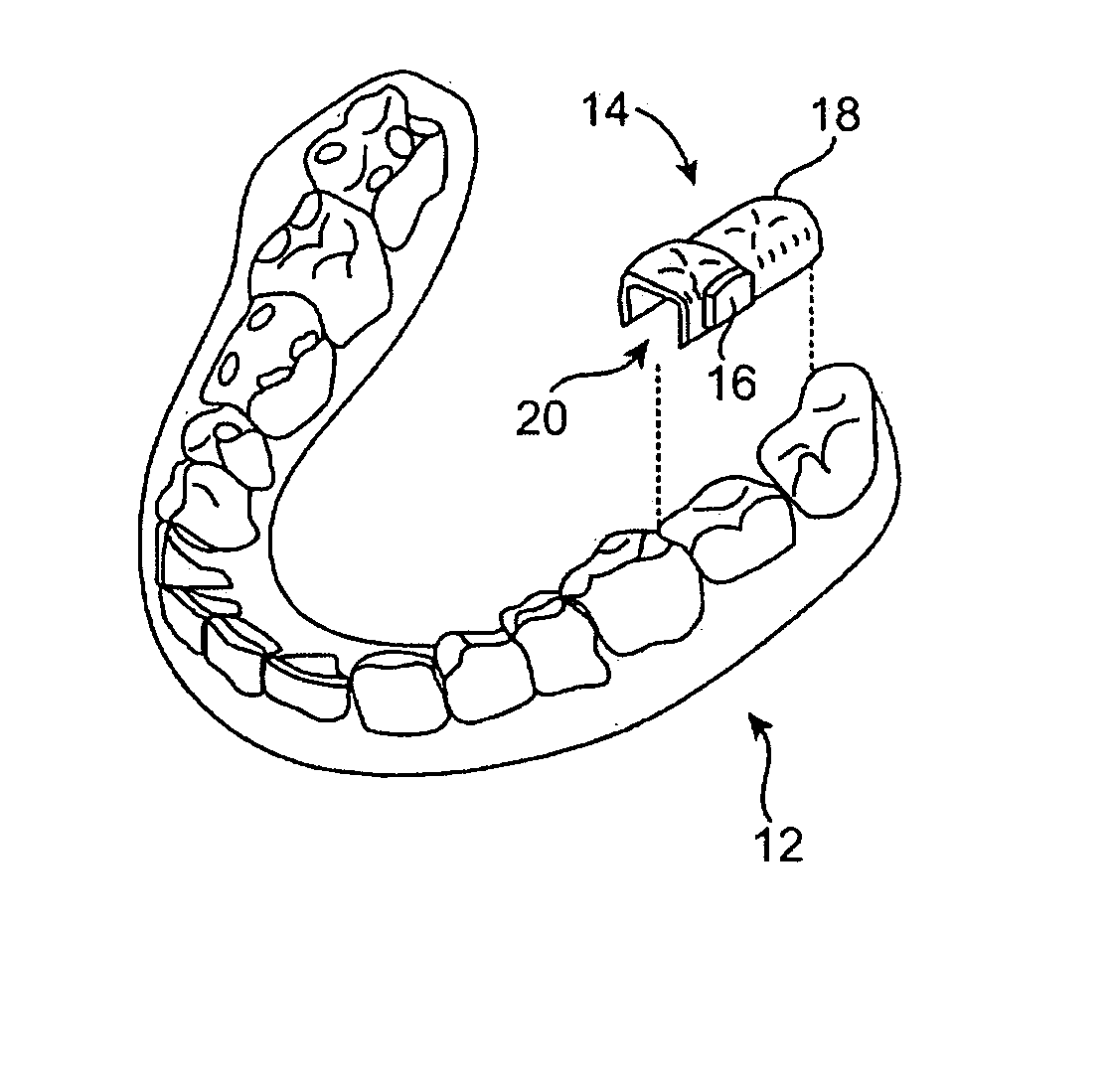 Systems for manufacturing oral-based hearing aid appliances