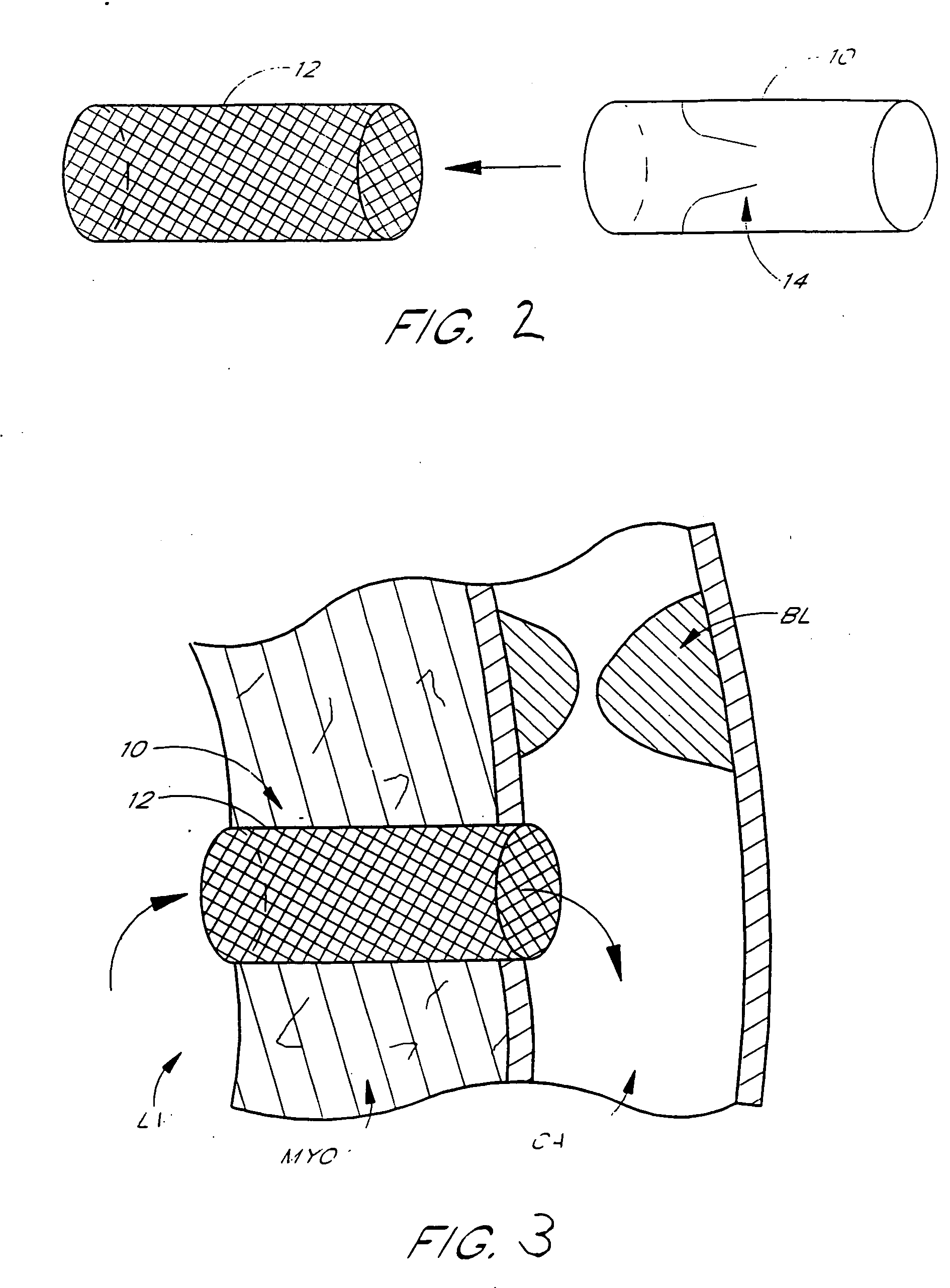 Left ventricular conduit with blood vessel graft