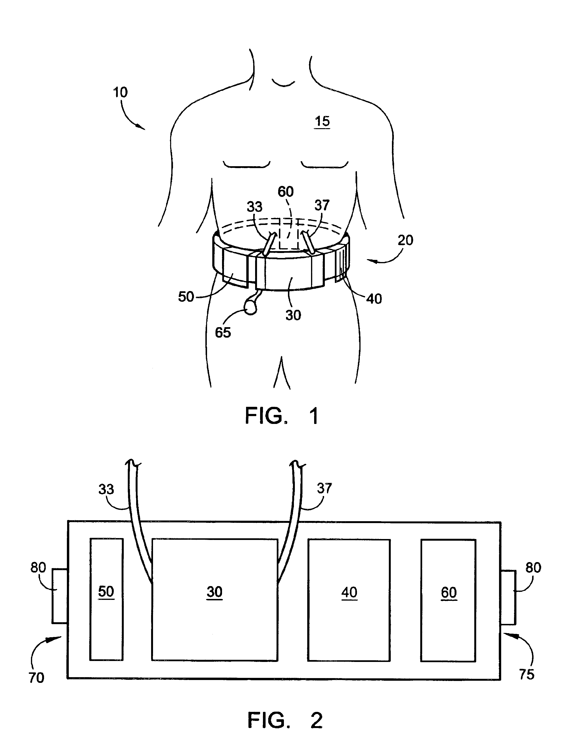 Wearable continuous renal replacement therapy device