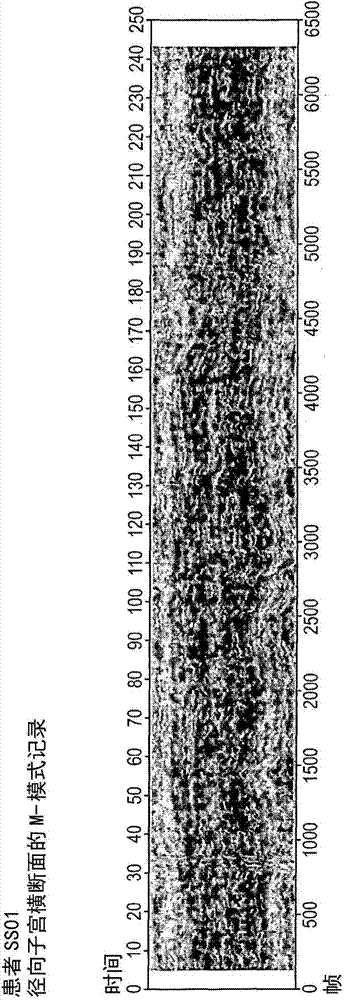 Method and system for diagnosing uterine contraction levels using image analysis