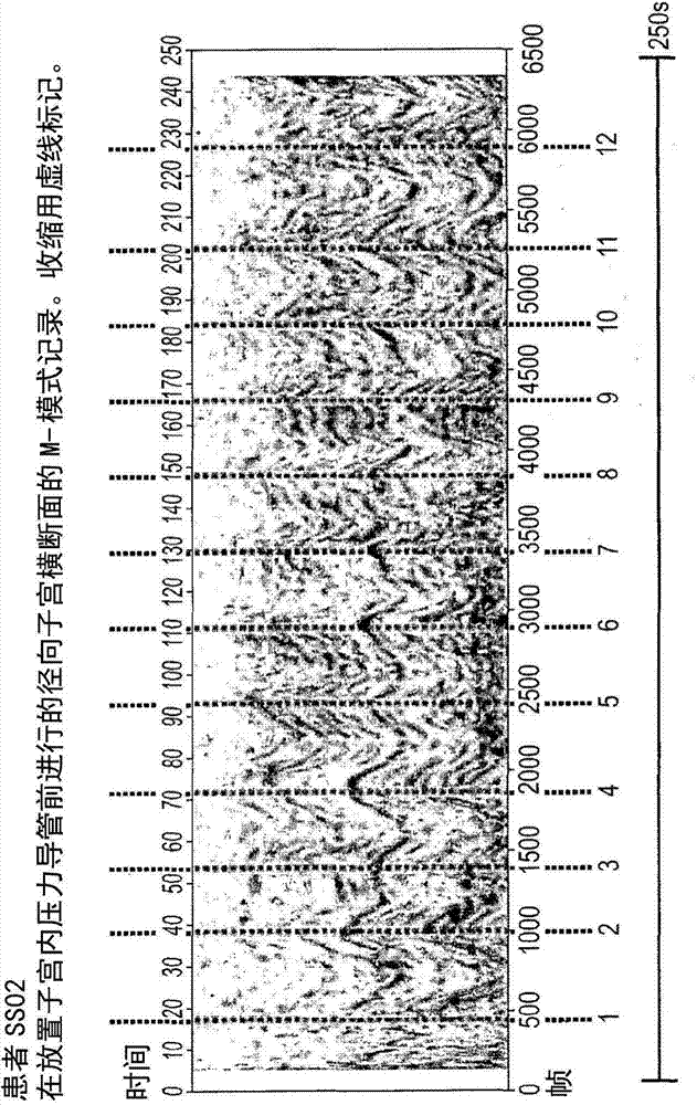 Method and system for diagnosing uterine contraction levels using image analysis