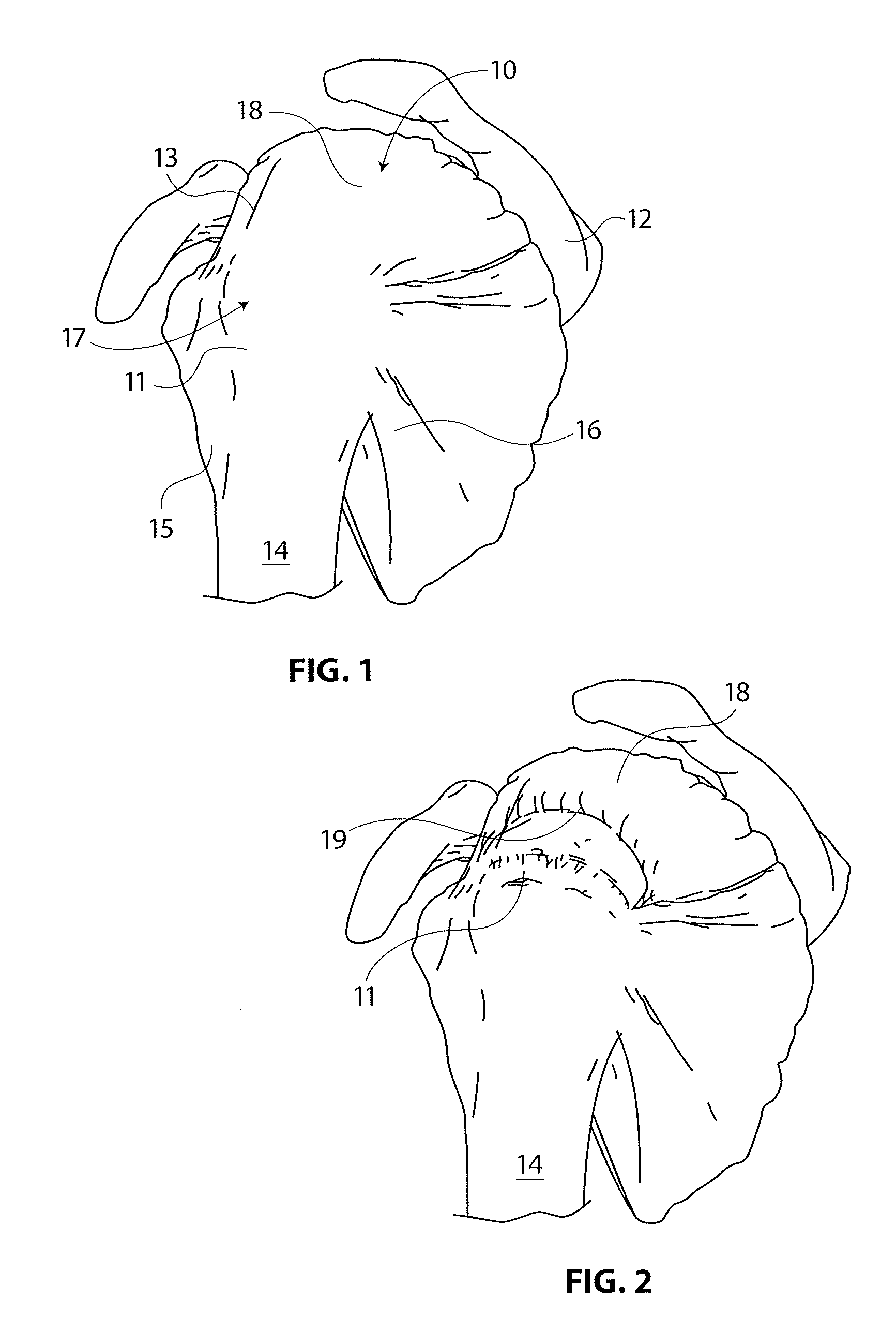 Tendon repair implant and method of arthroscopic implantation