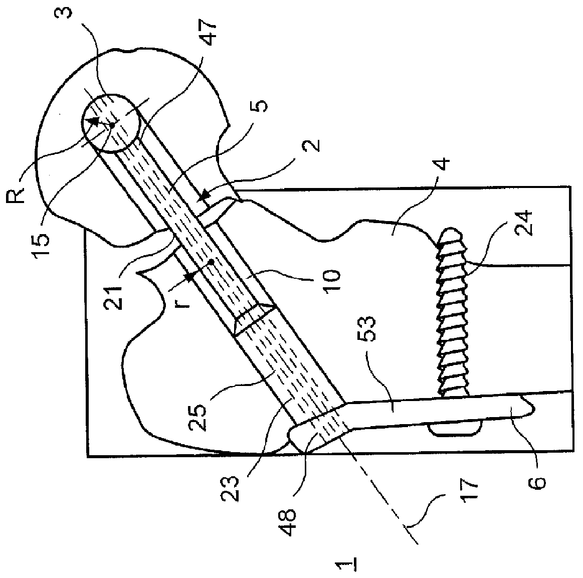 Bone Implant