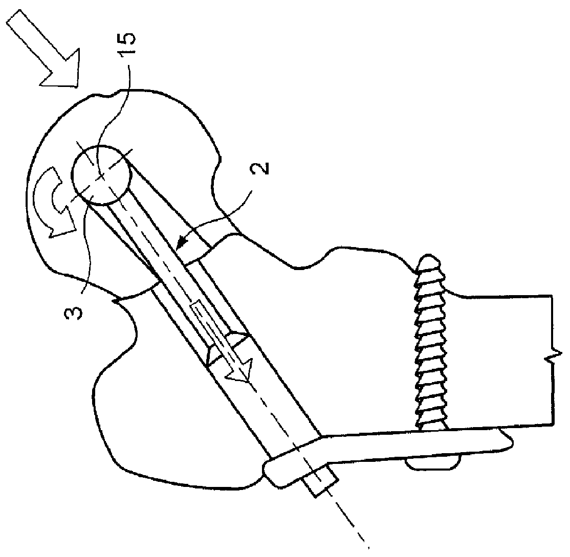 Bone Implant