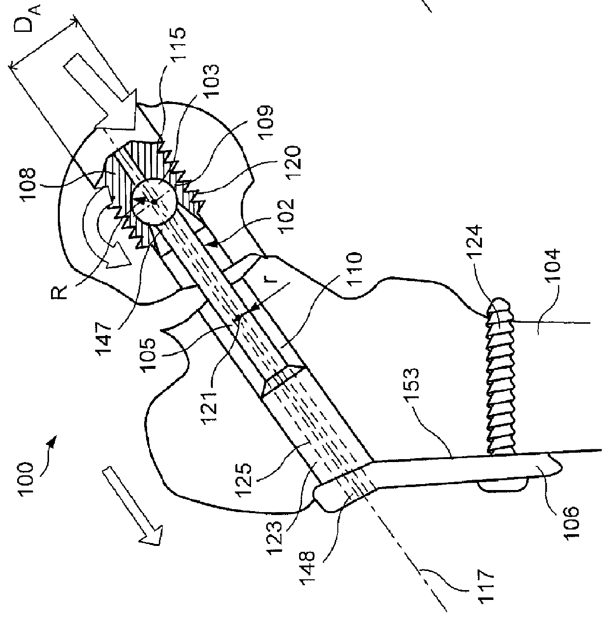 Bone Implant