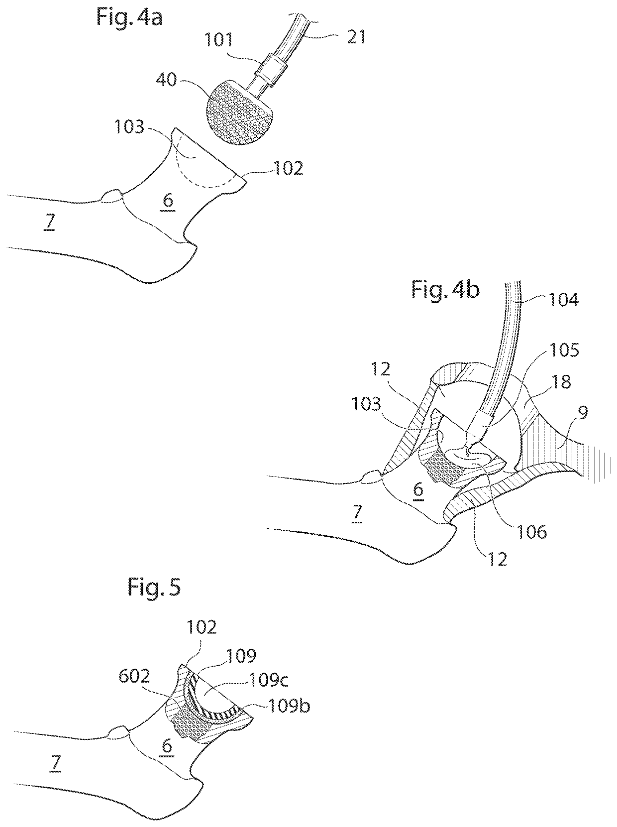 Hip joint device and method