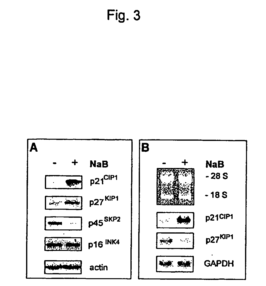 Use of an histone deacetylase inhibitor for the treatment of diseases associated with an hpv infection