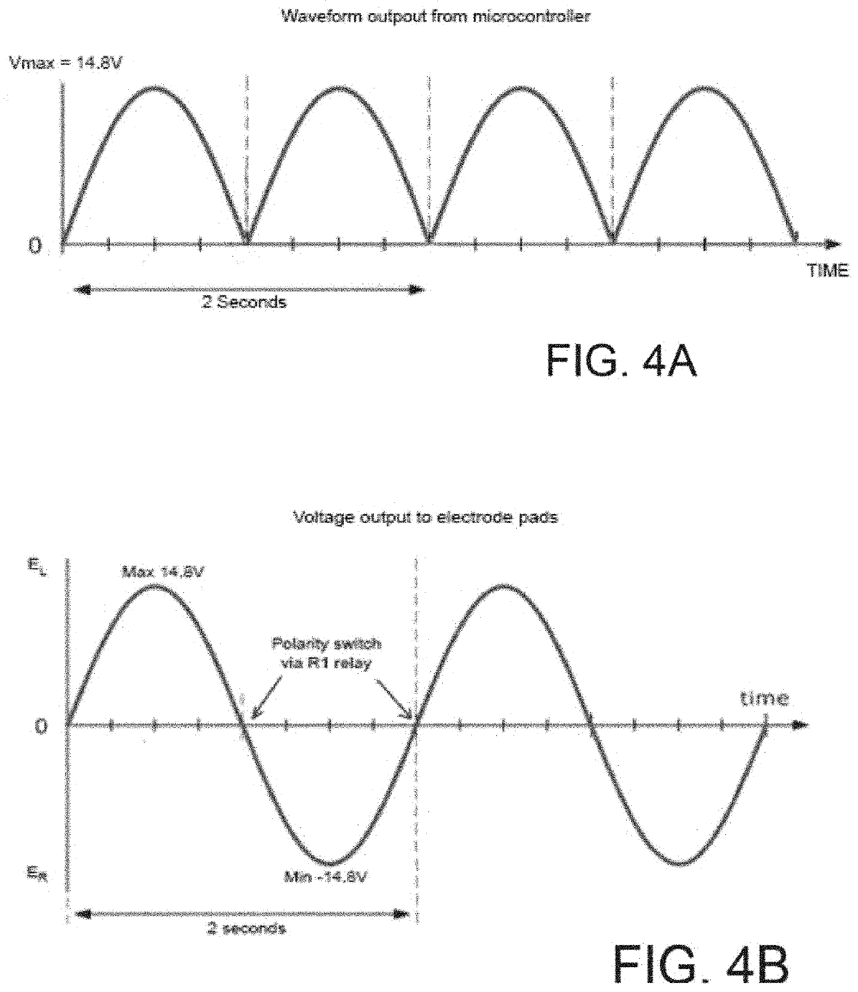 Systems, devices and methods for anxiety treatment using vestibular nerve stimulation