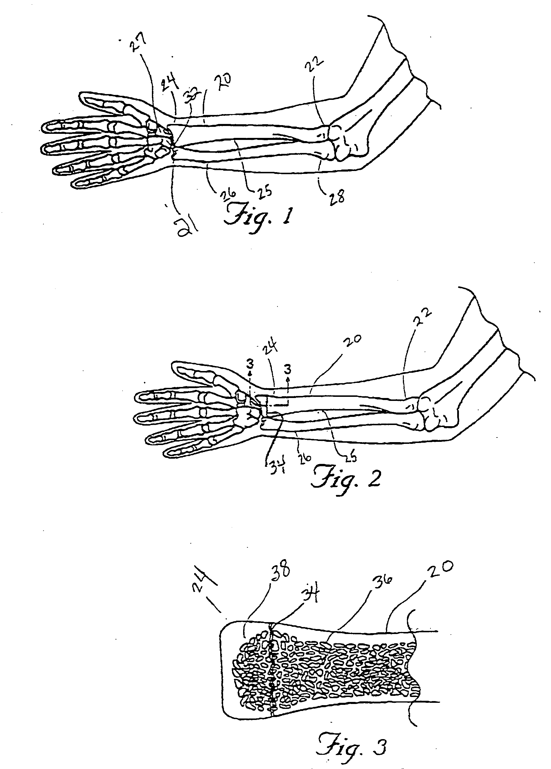 Systems and methods for reducing fractured bone using a fracture reduction cannula