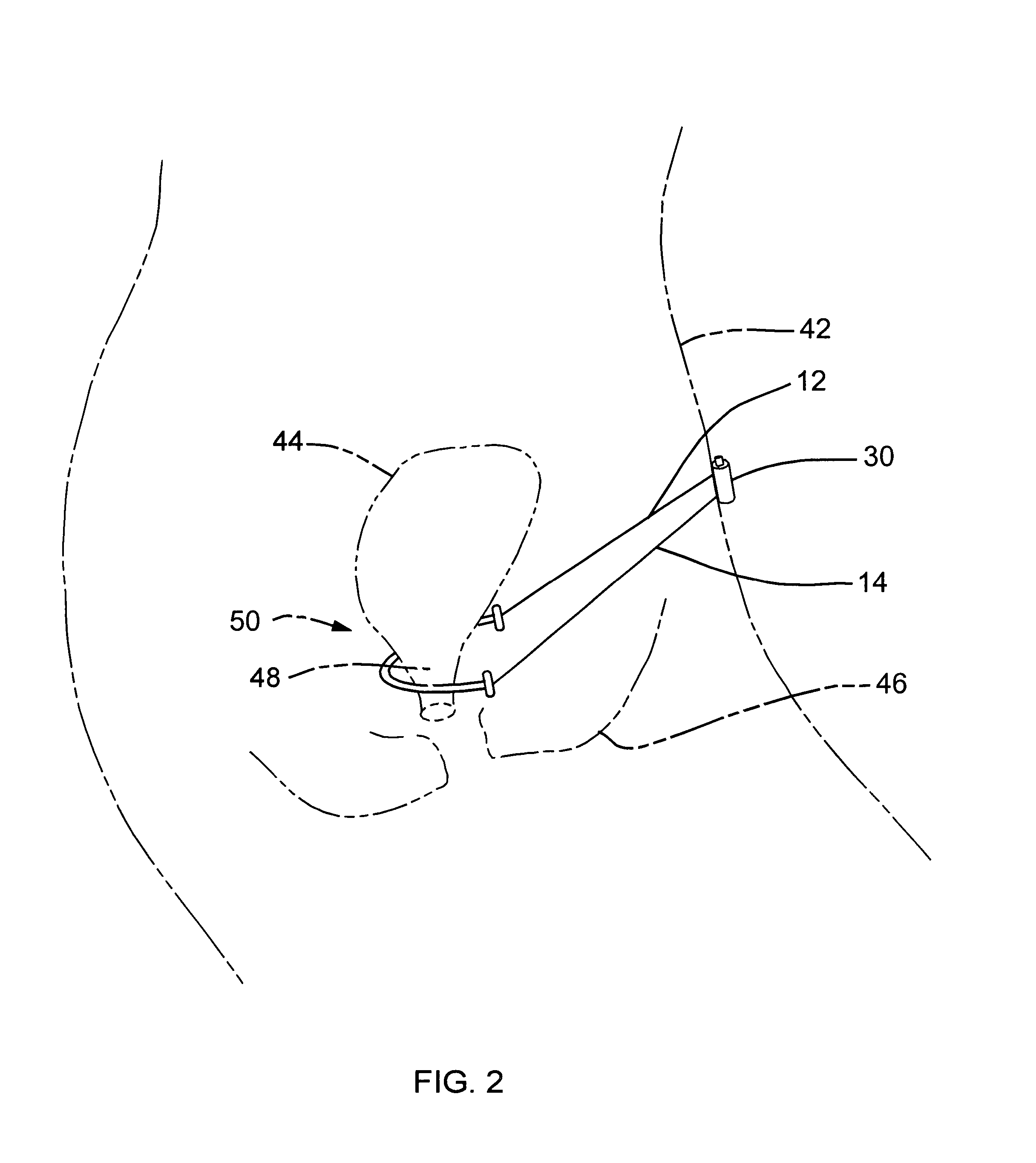 Absorbable pubovaginal sling system and method