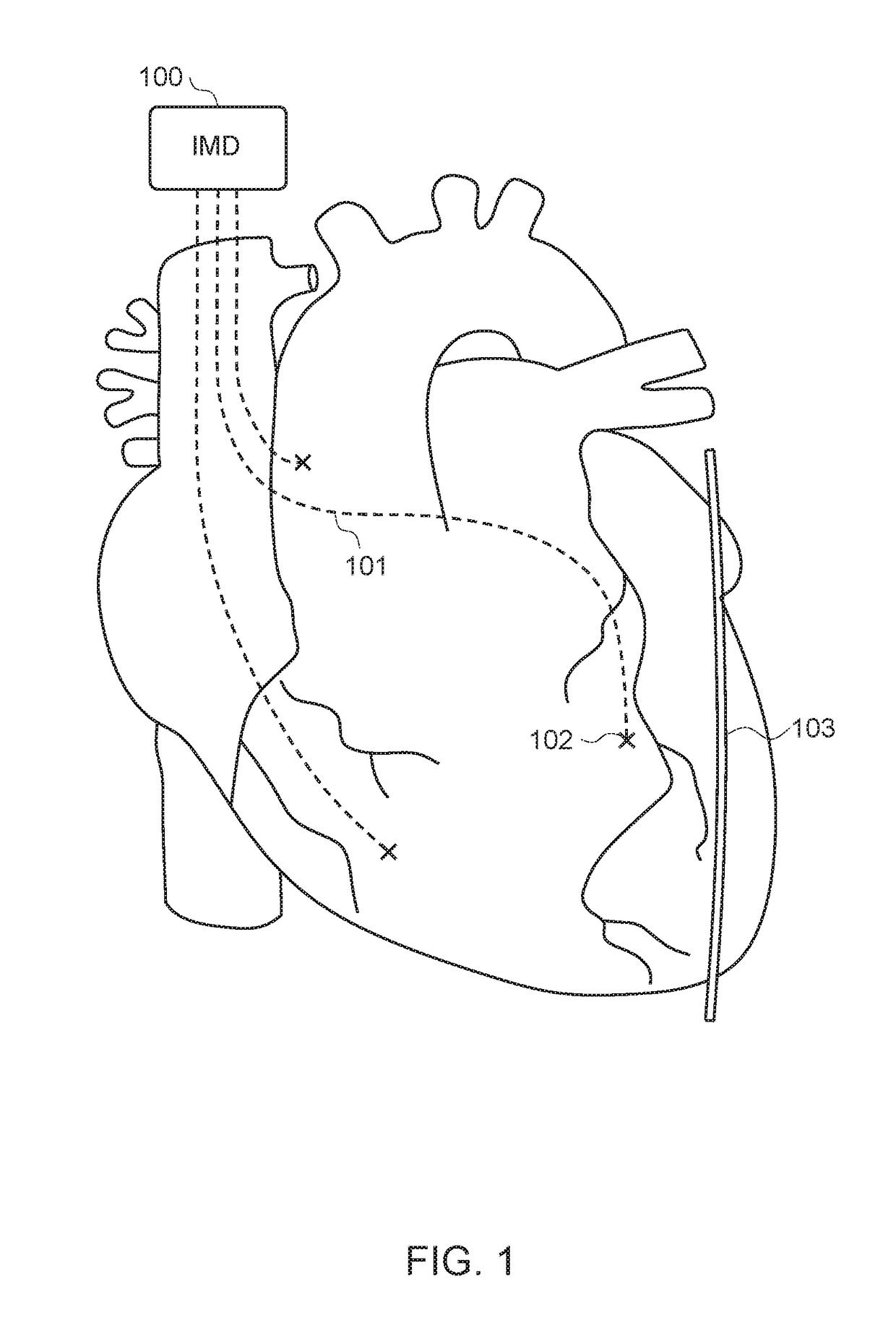 Ambulatory phrenic nerve stimulation detection