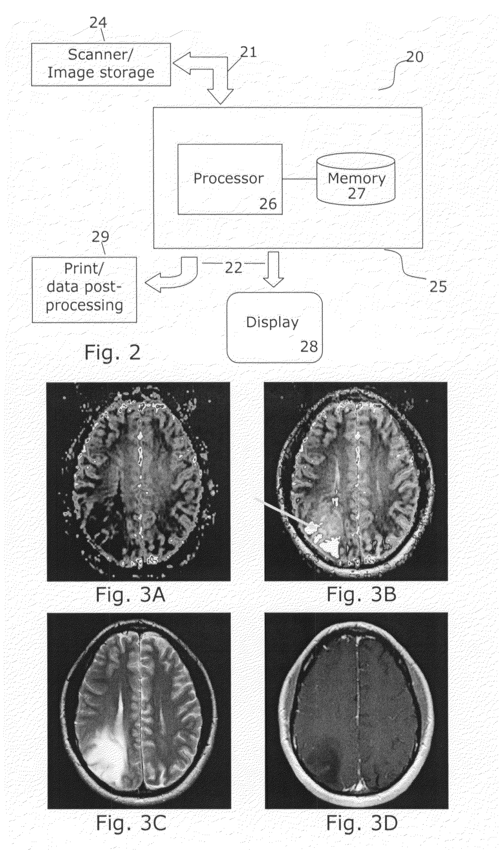 Tumor grading from blood volume maps