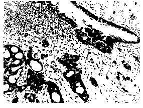 Histological classification immunohistochemical multiple staining detection method for lung cancer