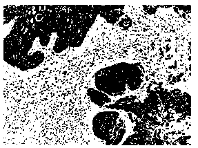 Histological classification immunohistochemical multiple staining detection method for lung cancer