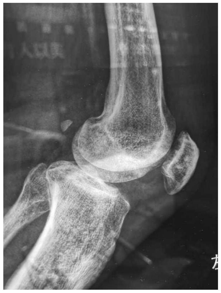 Bone-setting application pulvis