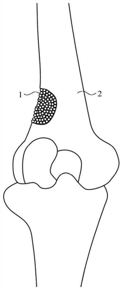 Degradable artificial bone particles with core-shell structure and preparation method thereof