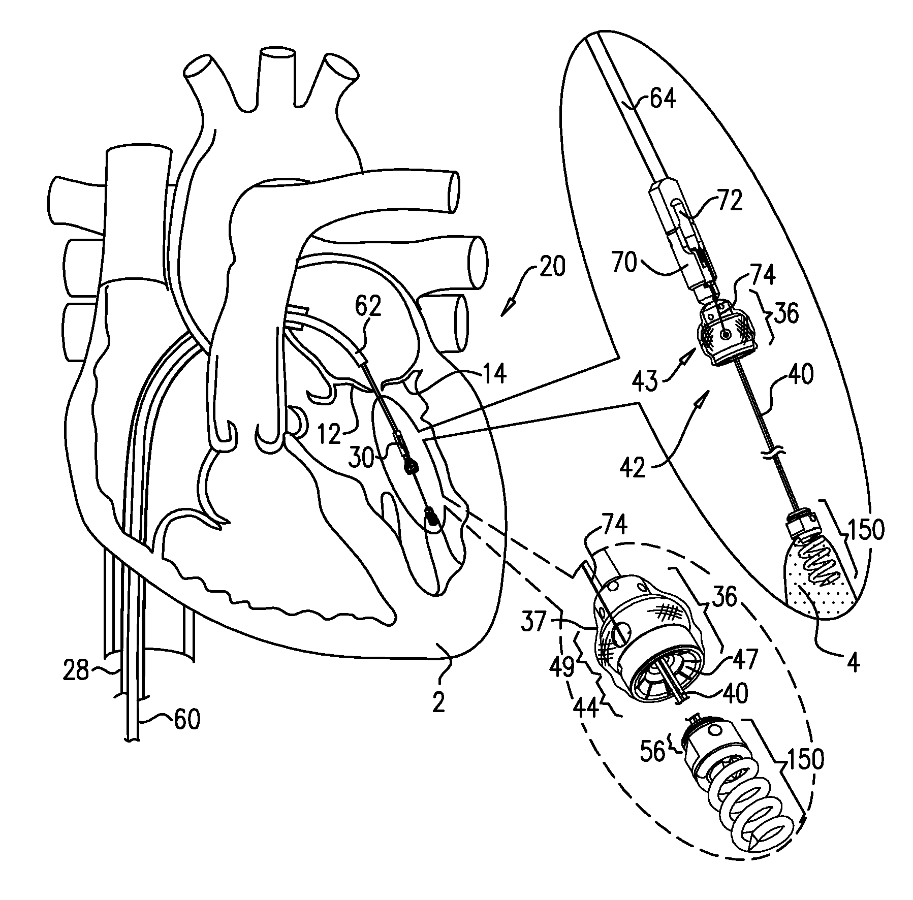 Apparatus and method for guide-wire based advancement of an adjustable implant