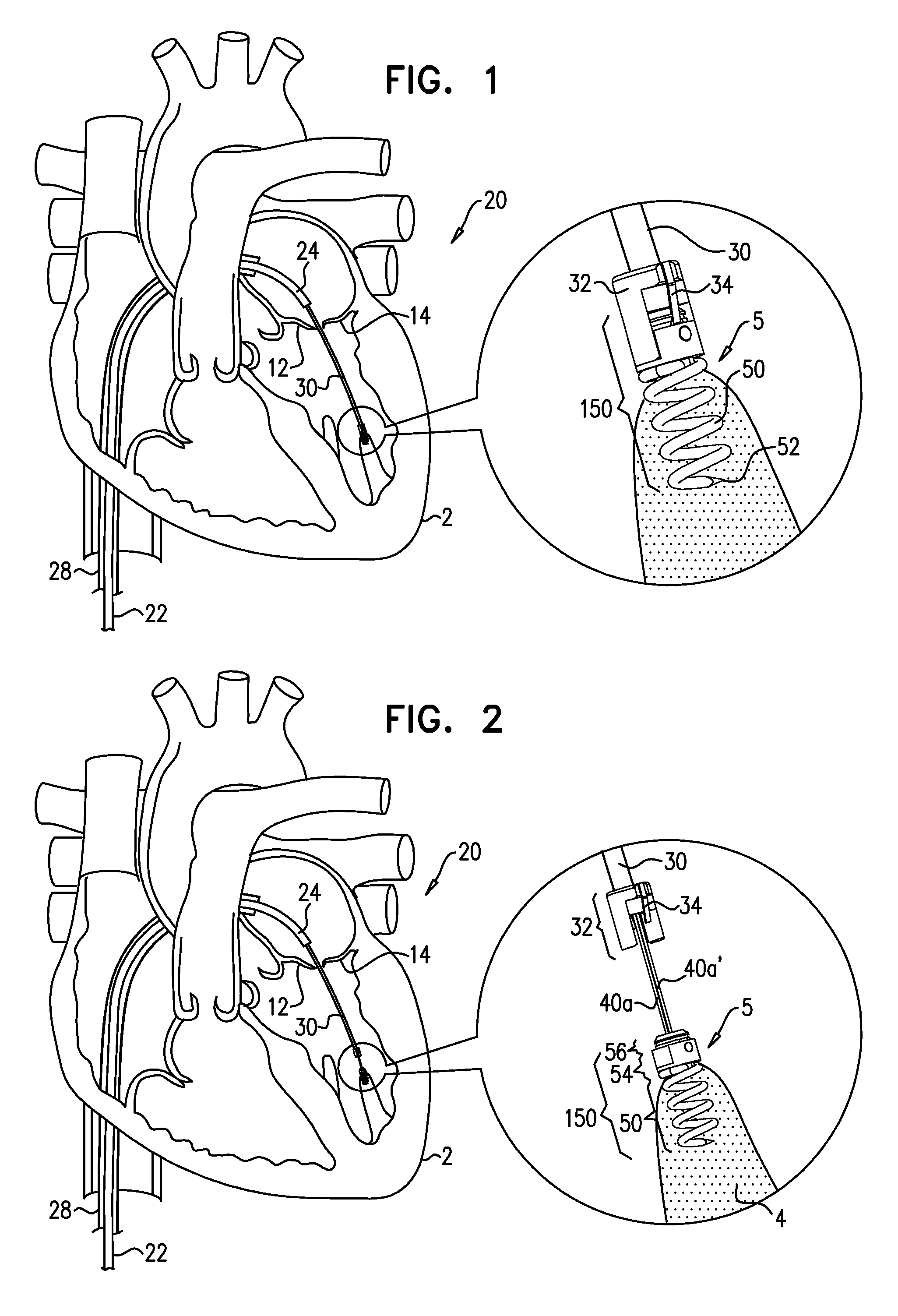 Apparatus and method for guide-wire based advancement of an adjustable implant