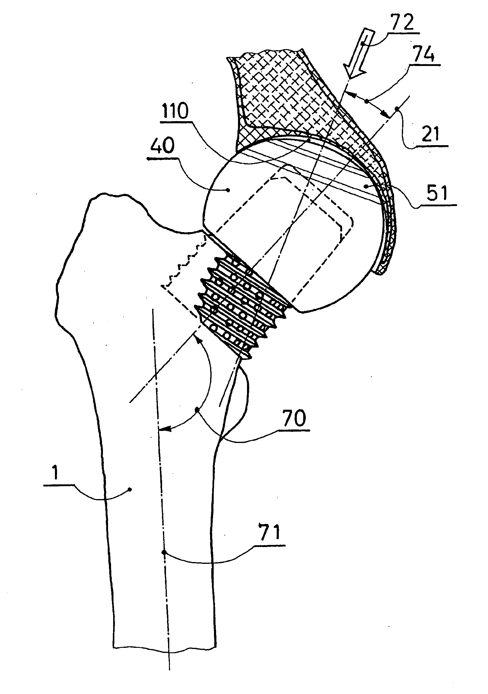 Partial hip prosthesis