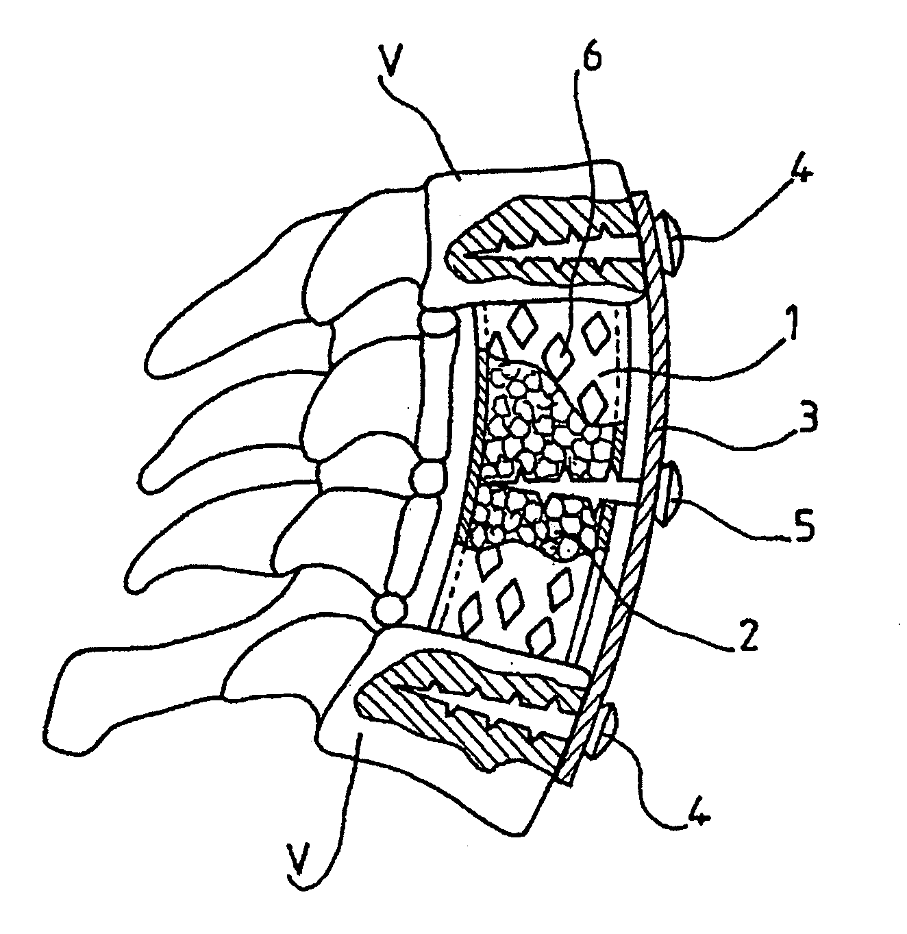 Method for repairing bone