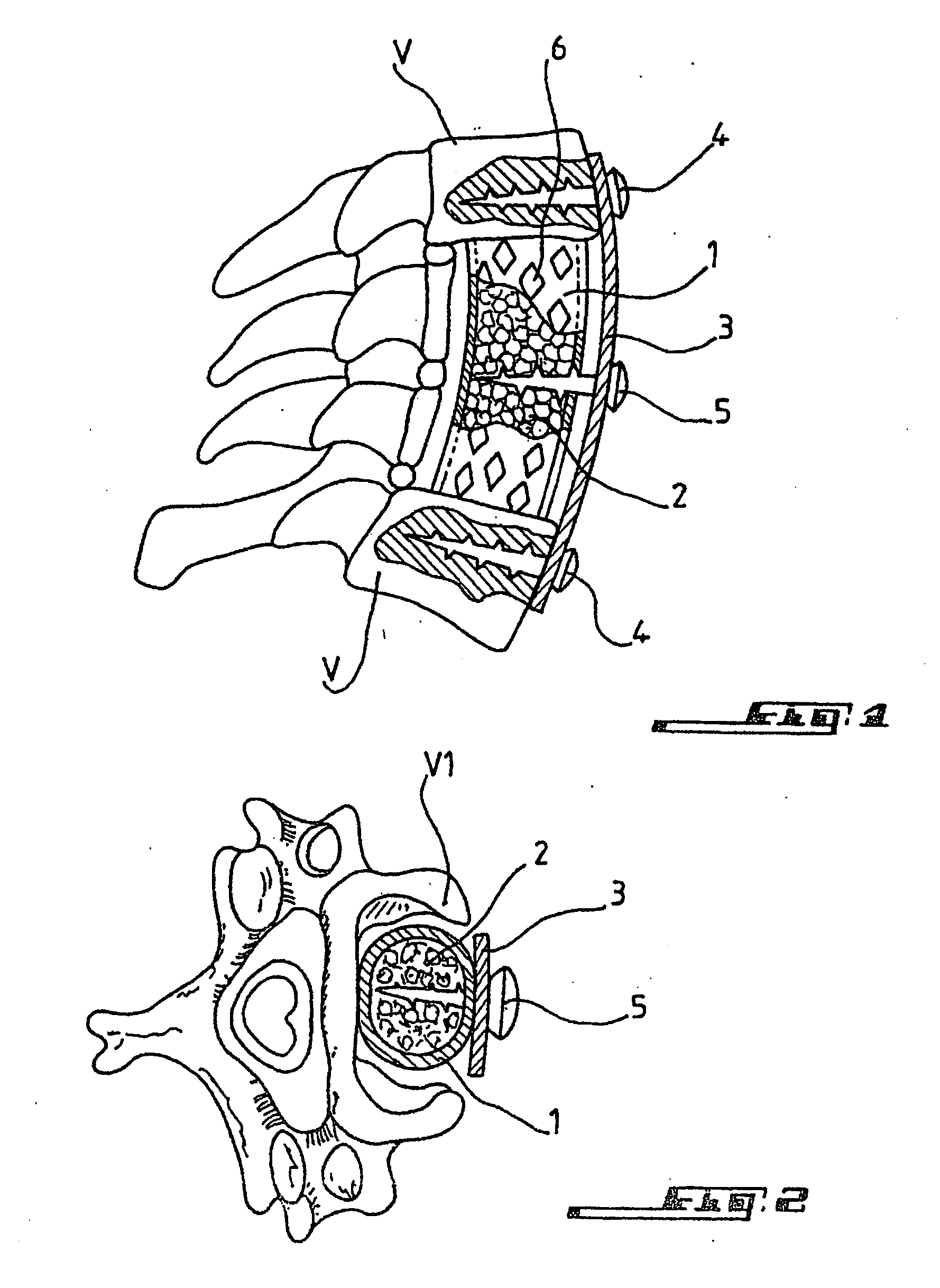 Method for repairing bone