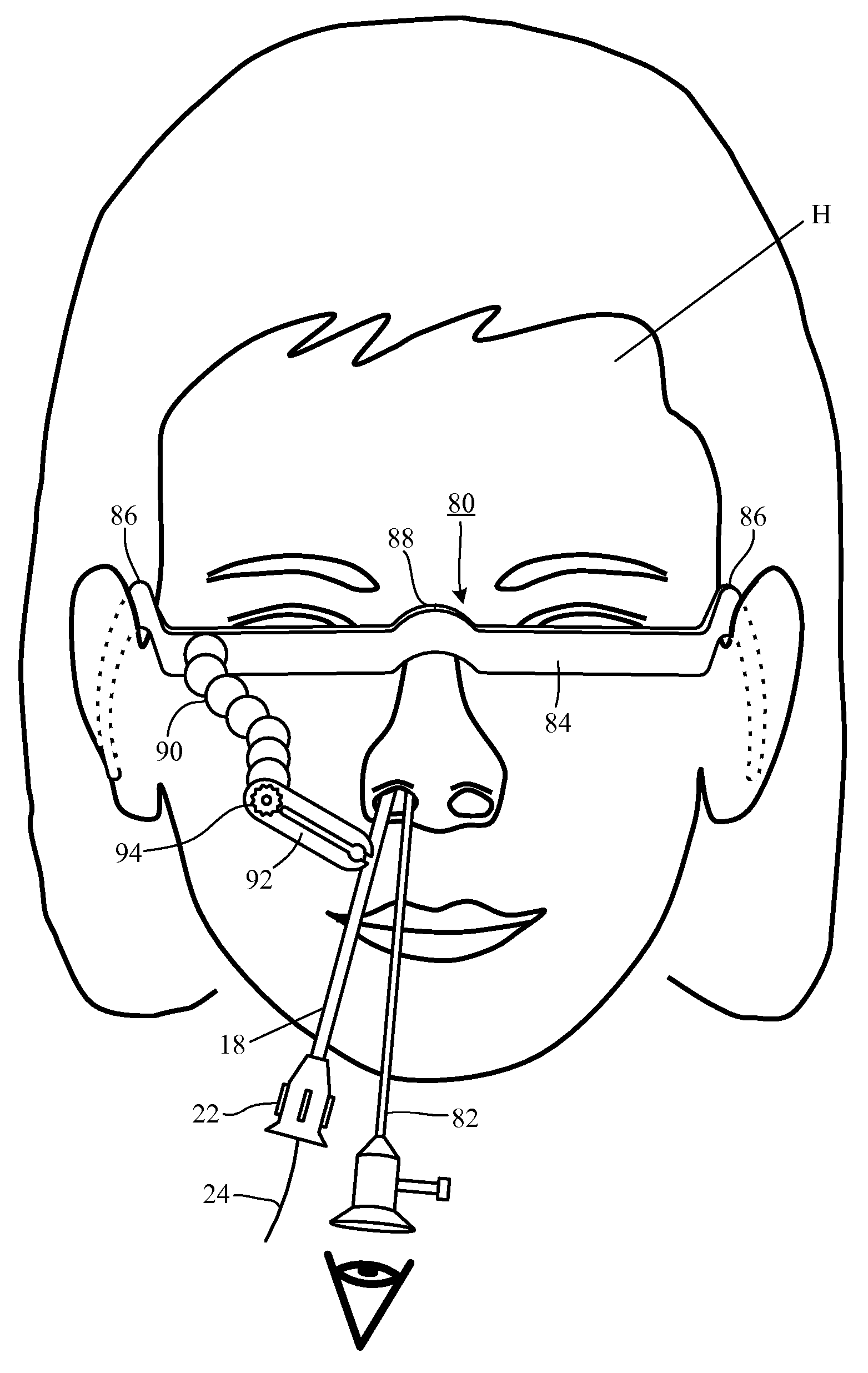 Guide catheter and method of use