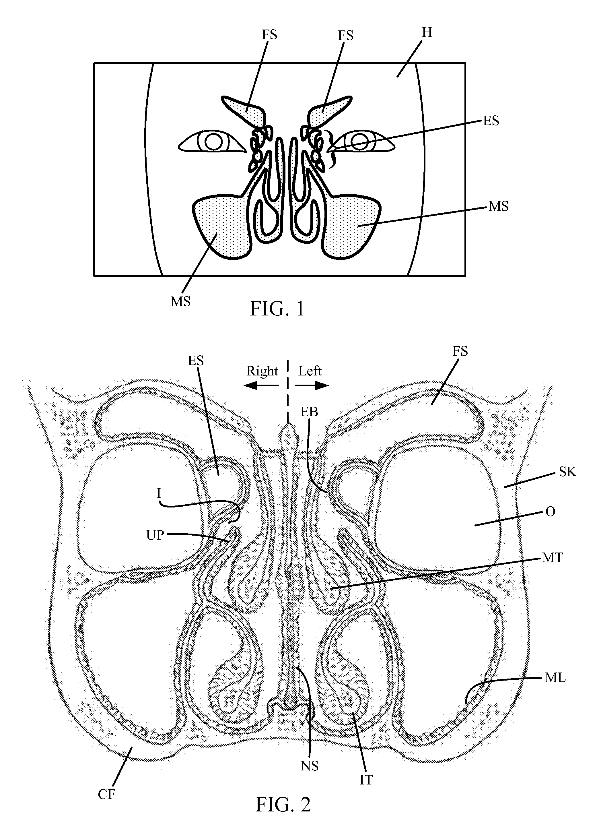 Guide catheter and method of use