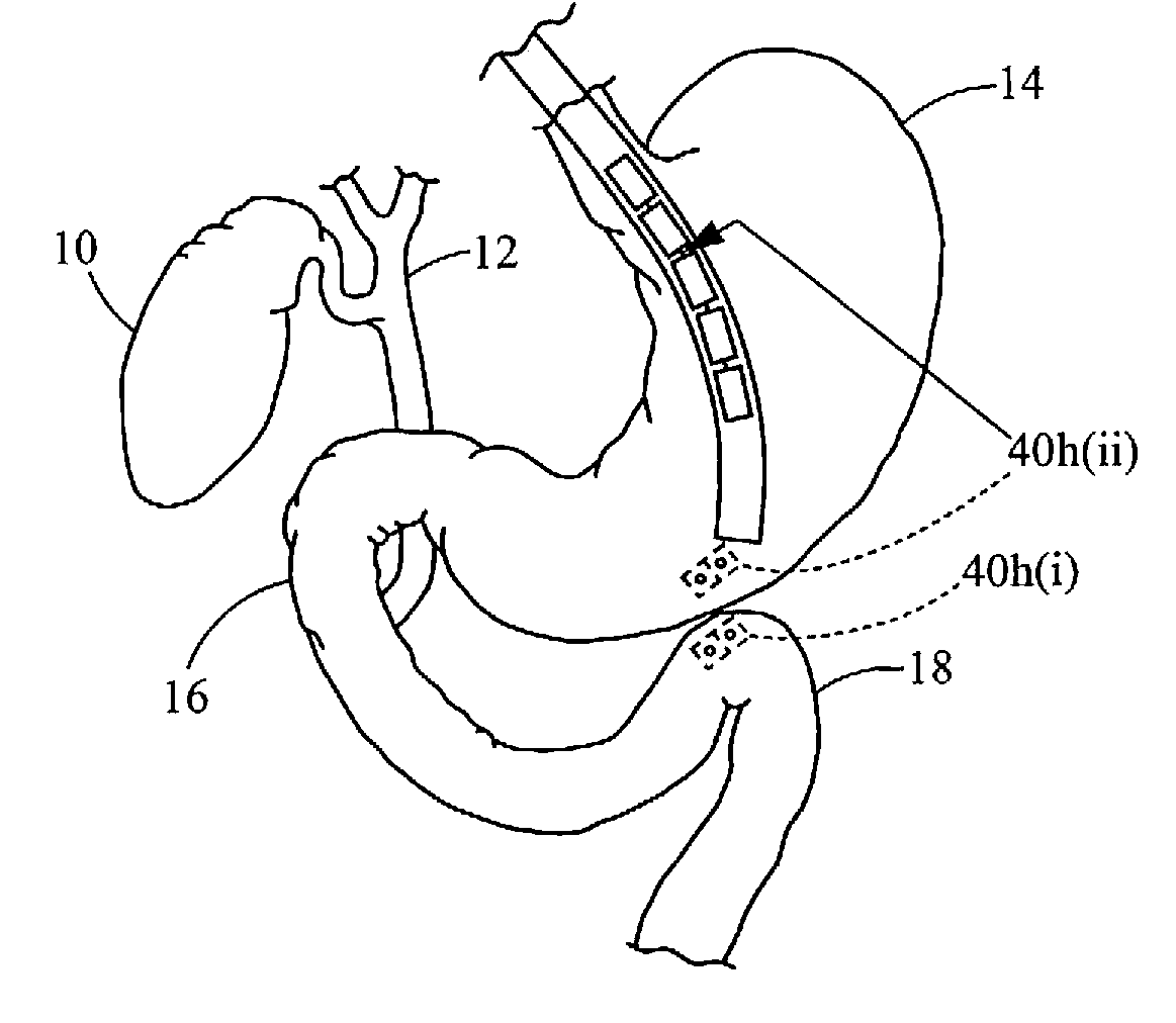 Magnetic anastomosis device having improved delivery