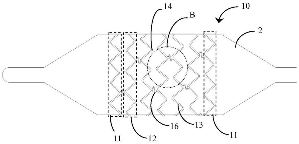 Infant pulmonary artery stent