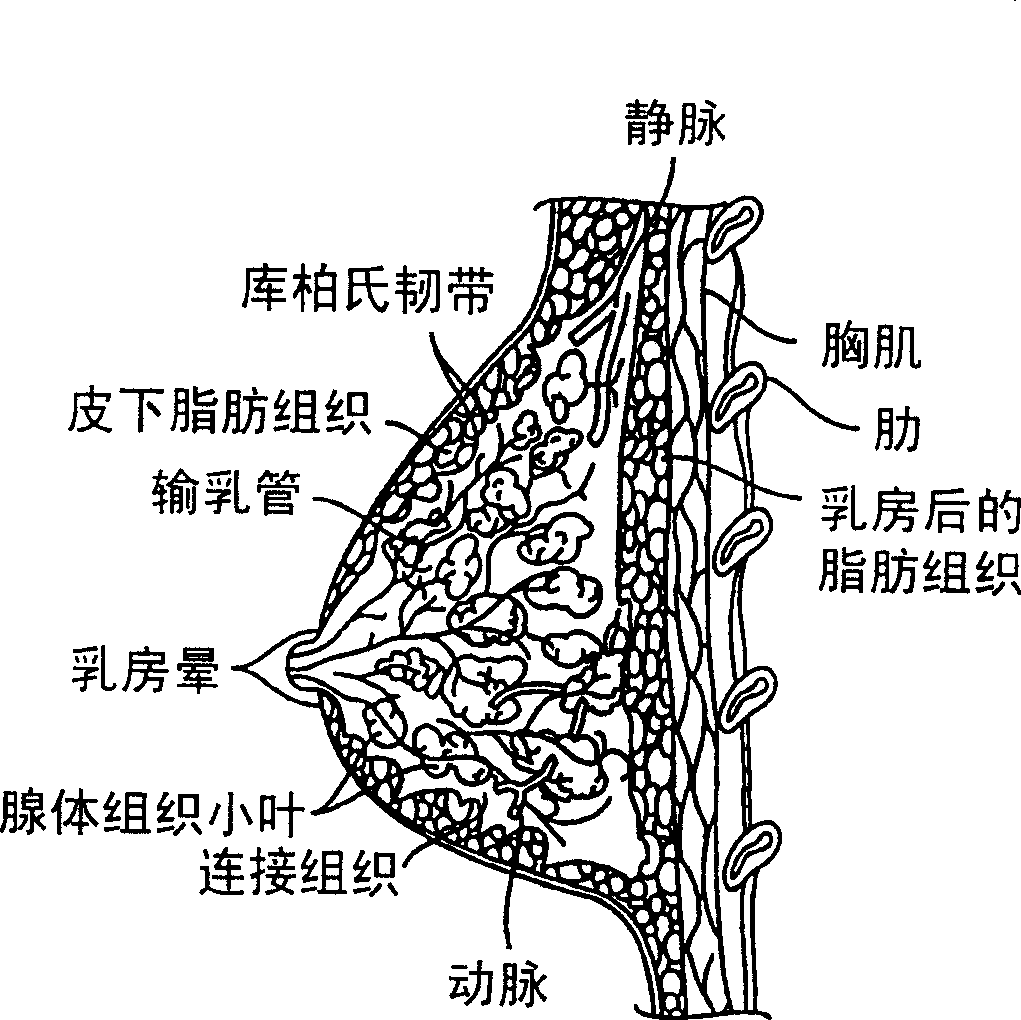 Apparatus for treating breast lesions using microwaves