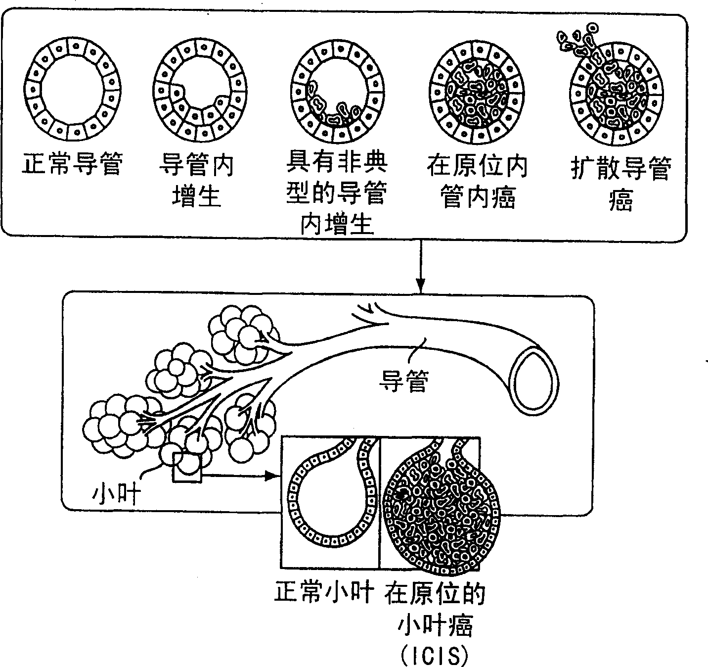 Apparatus for treating breast lesions using microwaves