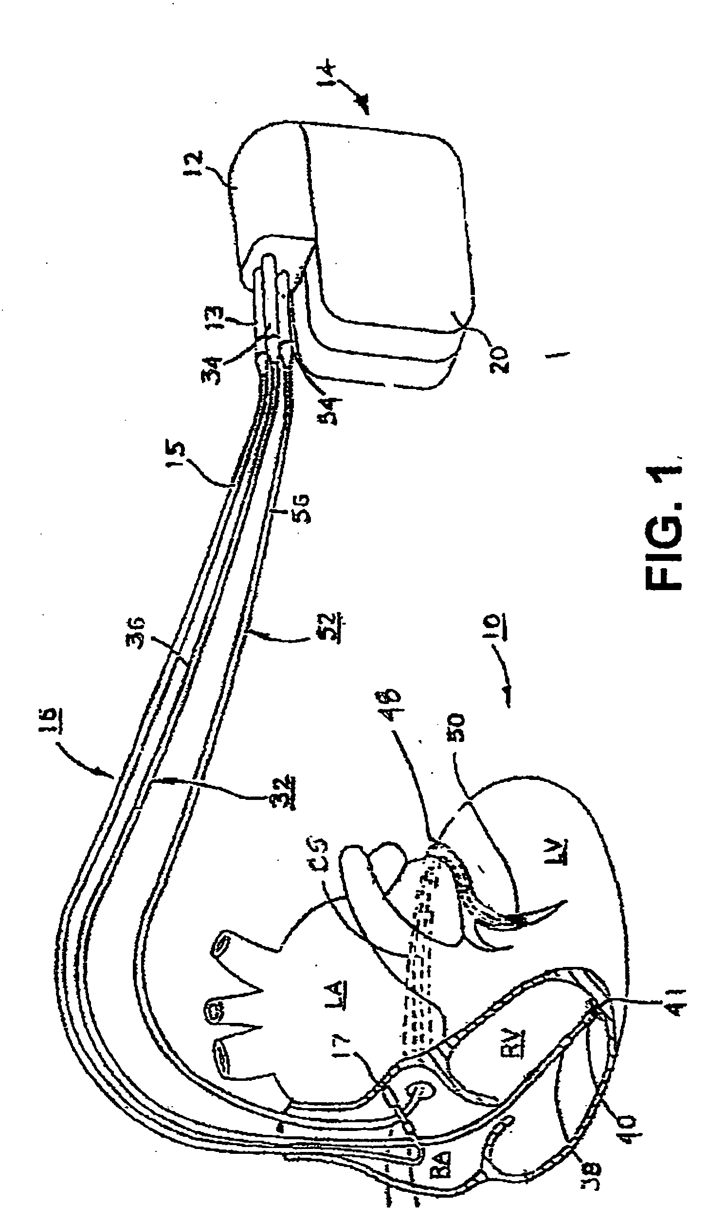 Method and apparatus for optimizing cardiac resynchronization therapy