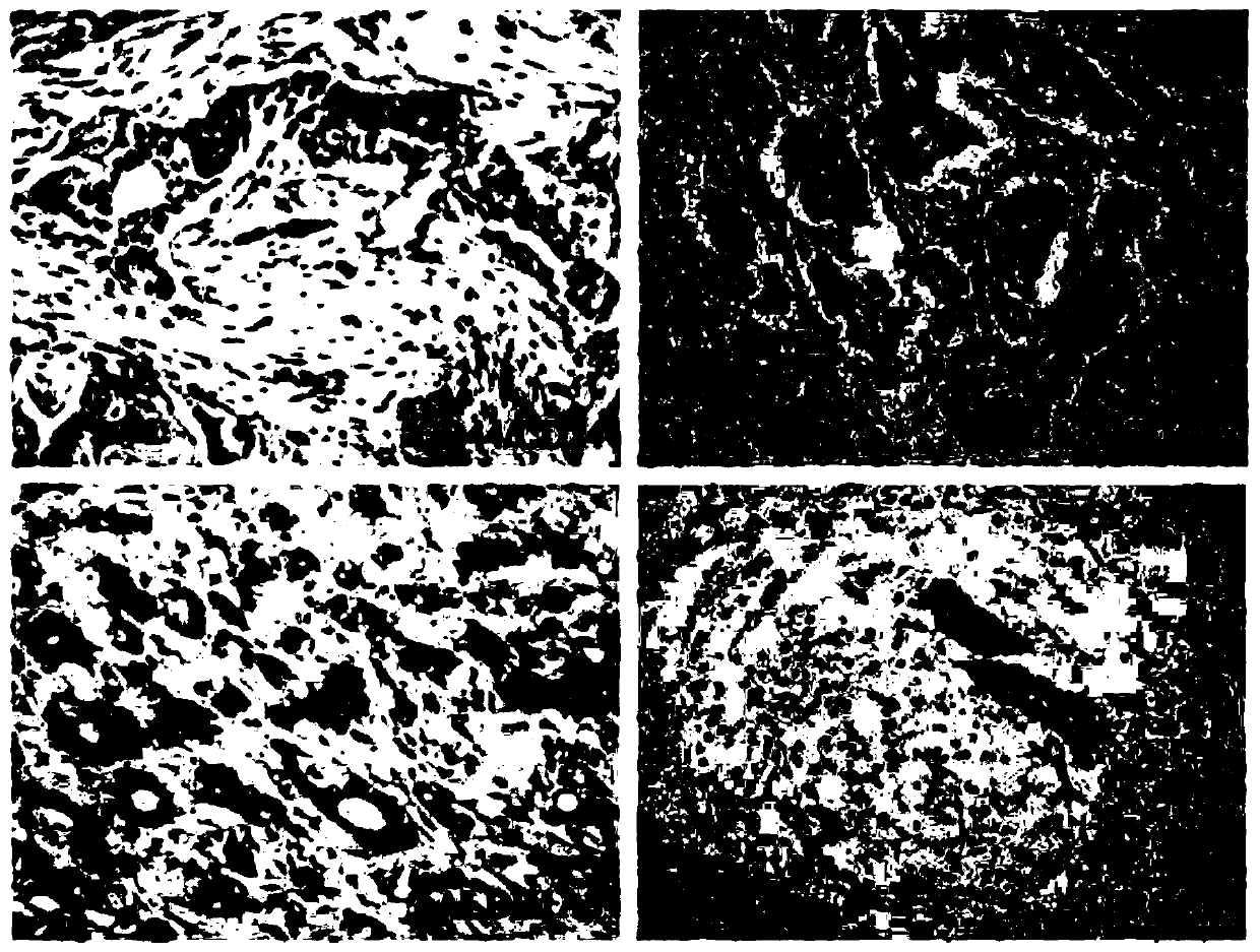 A kit for predicting recurrence of breast cancer