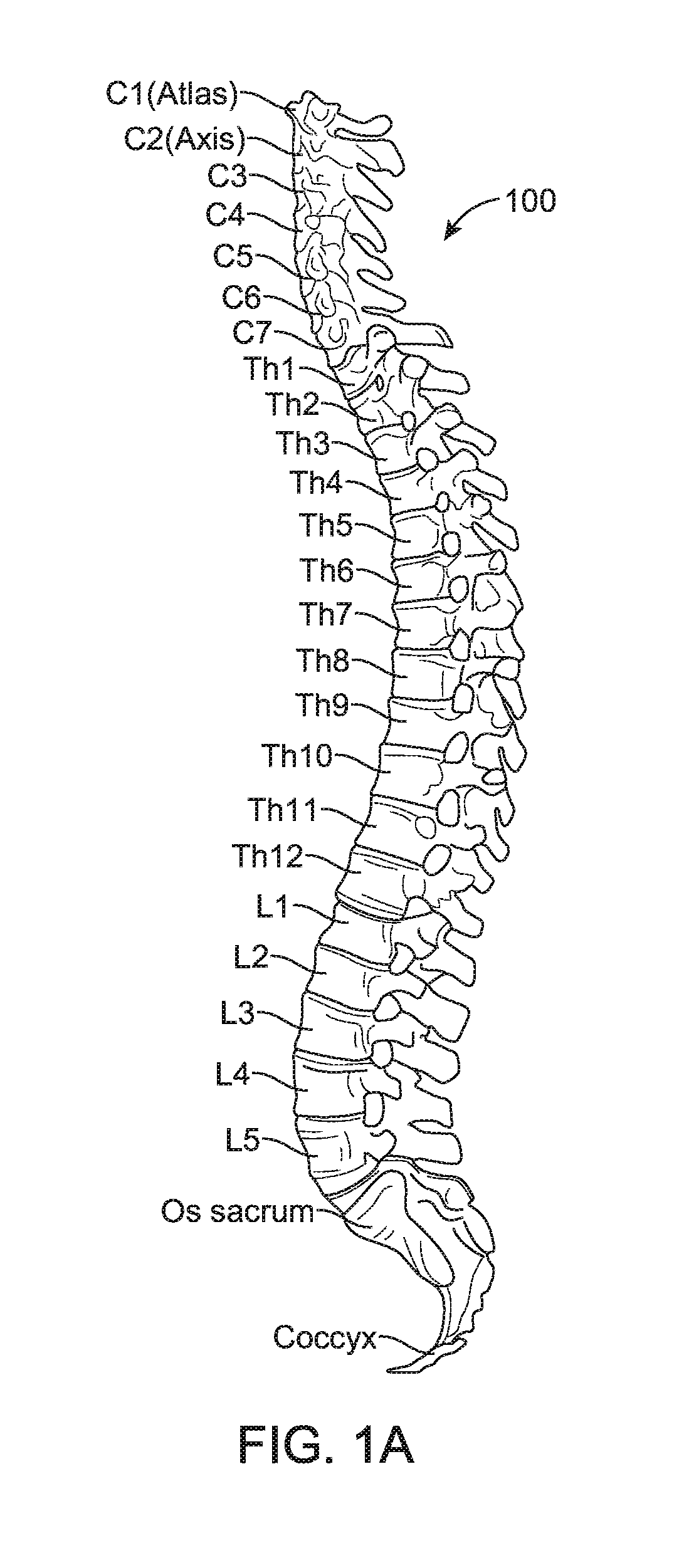 Method for preventing vertebra displacement after spinal fusion surgery