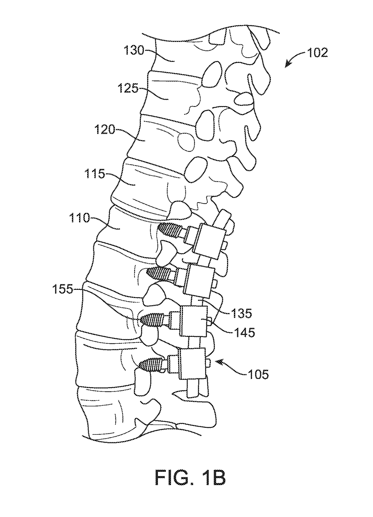 Method for preventing vertebra displacement after spinal fusion surgery