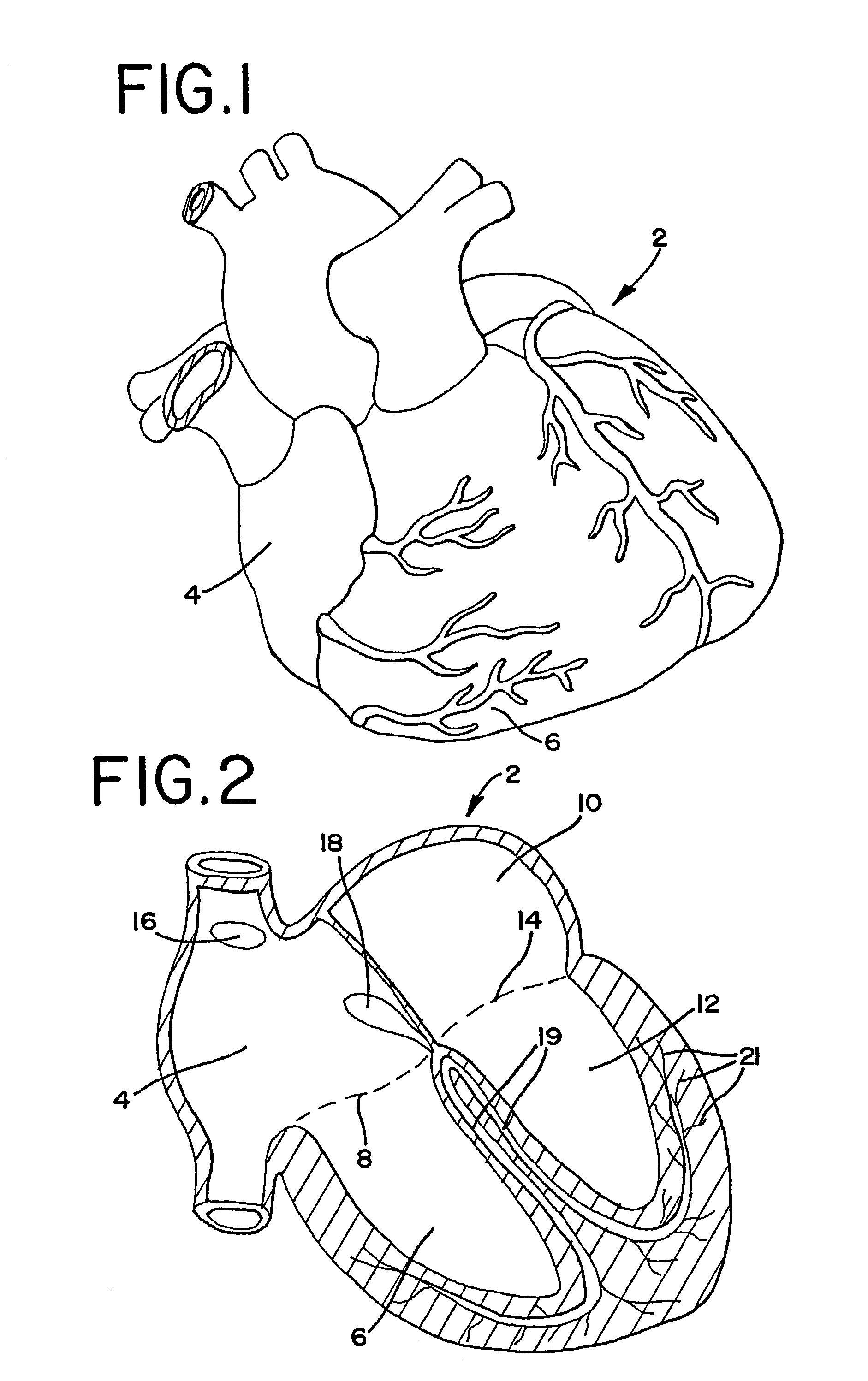 Methods and apparatus employing ionizing radiation for treatment of cardiac arrhythmia