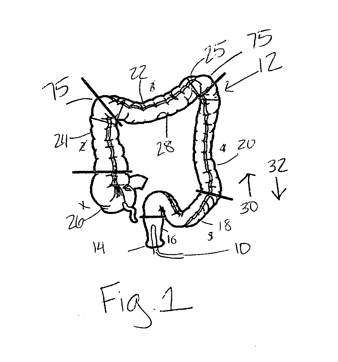 Colonoscopy video processing for quality metrics determination