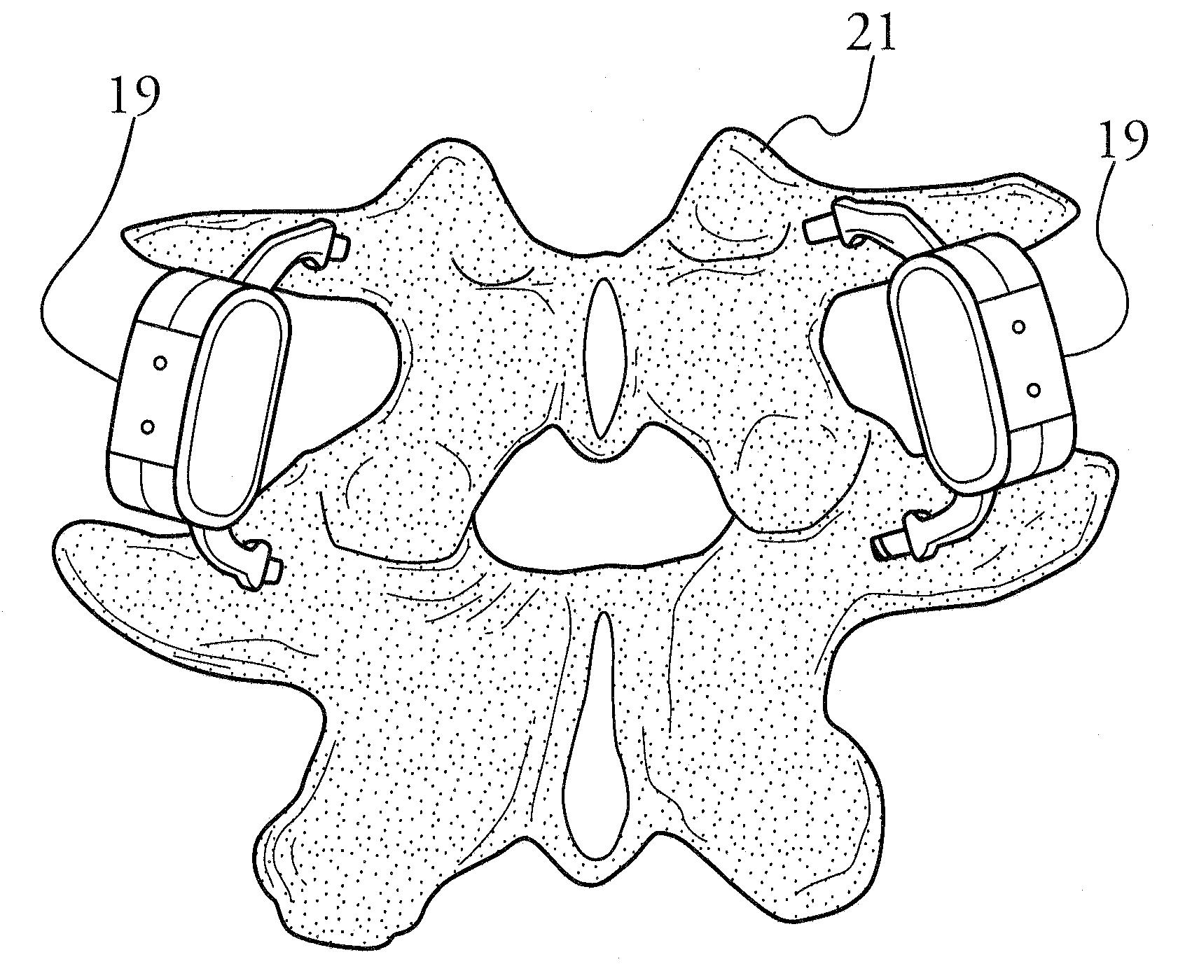 Device and method for implantation that restores physiologic range of motion by establishing an adjustable constrained motion of the spine without intrusion of associated facet joints